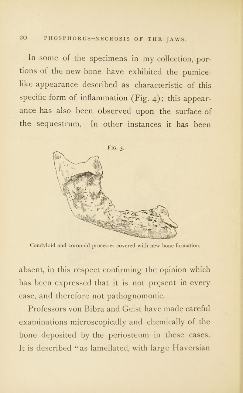 In some of the specimens in my collection, por- tions of the new bone have exhibited the pumice- like appearance described as characteristic of this specific form of inflammation (Fig. 4); this appear- ance has also been observed upon the surface of the sequestrum. In other instances it has been Fig. 3. Condyloid and coronoid processes covered with new bone formation. absent, in this respect confirming the opinion which has been expressed that it is not present in every case, and therefore not pathognomonic. Professors von Bibra and Geist have made careful examinations microscopically and chemically of the bone deposited by the periosteum in these cases. It is described “as lamellated, with large Haversian