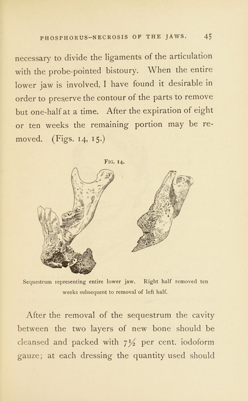 necessary to divide the ligaments of the articulation with the probe-pointed bistoury. When the entire lower jaw is involved, I have found it desirable in order to pres.erve the contour of the parts to remove but one-half at a time. After the expiration of eight or ten weeks the remaining portion may be re- moved. (Figs. 14, 15.) Fig. 14. Sequestrum representing entire lower jaw. Right half removed ten weeks subsequent to removal of left half. After the removal of the sequestrum the cavity between the two layers of new bone should be cleansed and packed with 7^ per cent, iodoform gauze; at each dressing the quantity used should