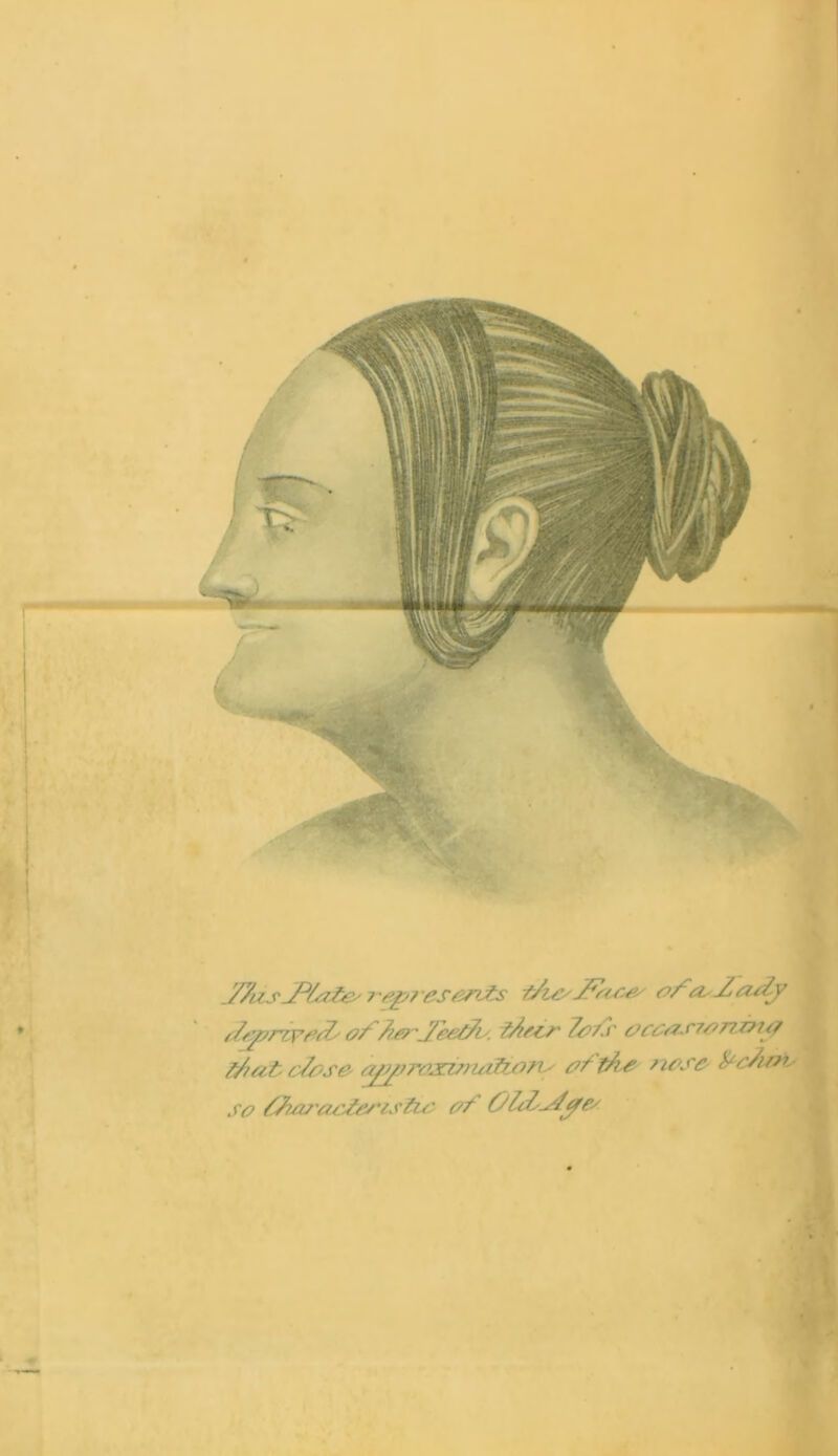 J7us jPhofe- rep? esen£s t/i&Zftoe' of cvZaZy Zrtprrr’fi/Z' of herJeetZi', ihecr Tefs occ/zs7onz7Uf Z/at cZese- a/j/jroximafiort' of the nose frhnv so Zho/'ocfeoistio of OlZ^Zifes