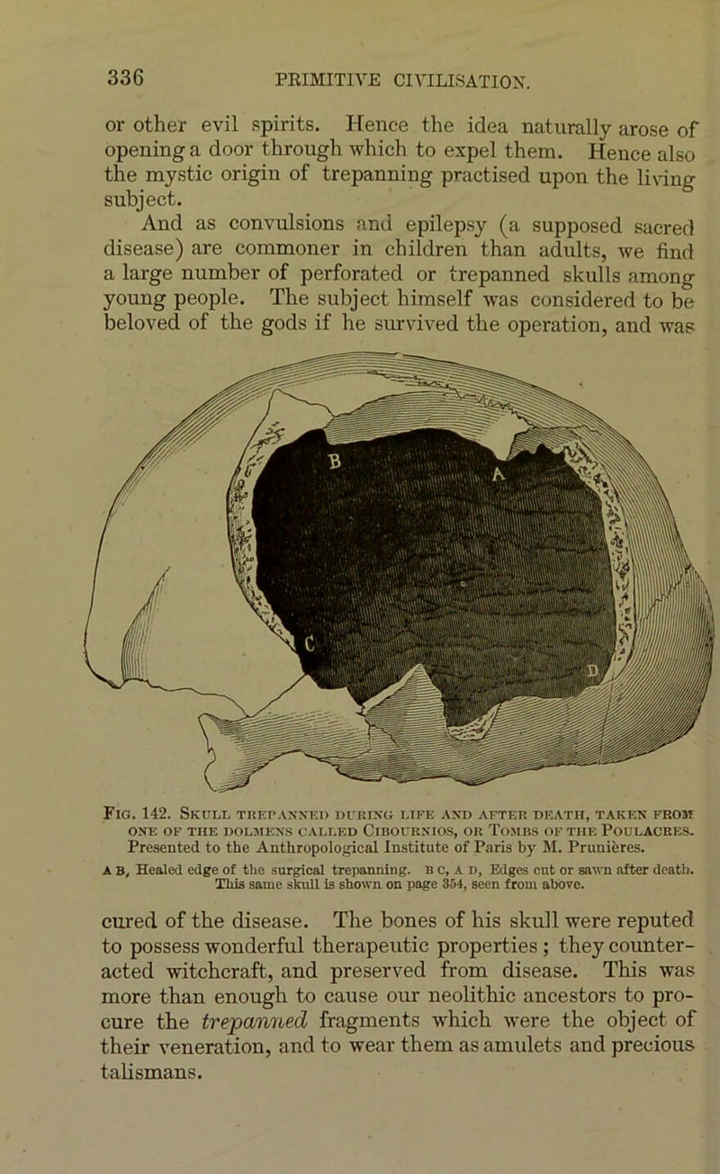 ciired of the disease. The bones of his skull were reputed to possess wonderful therapeutic properties ; they counter- acted witchcraft, and preserved from disease. This was more than enough to cause our neolithic ancestors to pro- cure the trejpanned fragments which were the object of their vénération, and to wear them as amulets and precious talismans. 336 PEIMITIVE CIVILISATION. or other evil spirits. Hence the idea natiirally arose of opening a door through which to expel them. Hence also the mystic origin of trepanning practised upon the living subject. And as convulsions and epilepsy (a supposed sacrecl disease) are commoner in children than adults, we find a large number of perforated or trepanned skulls among young people. The subject himself was considered to be beloved of the gods if he survived the operation, and was Fig. 142. Skull trep.vnxkd i>urixg ltfe axd after deatii, taken feom ONE OF TUE DOLMEX.S CALLED CiBOURSIOS, OR TOMBS OF THE POULACRES. Presented to the Anthropological Instituts of Paris by SI. Prunières. A B, Healed edge of the surgioal trepanning. b c, a n, Edges eut or sawn after deatb. This same skull is shown on page 354, seen from above.