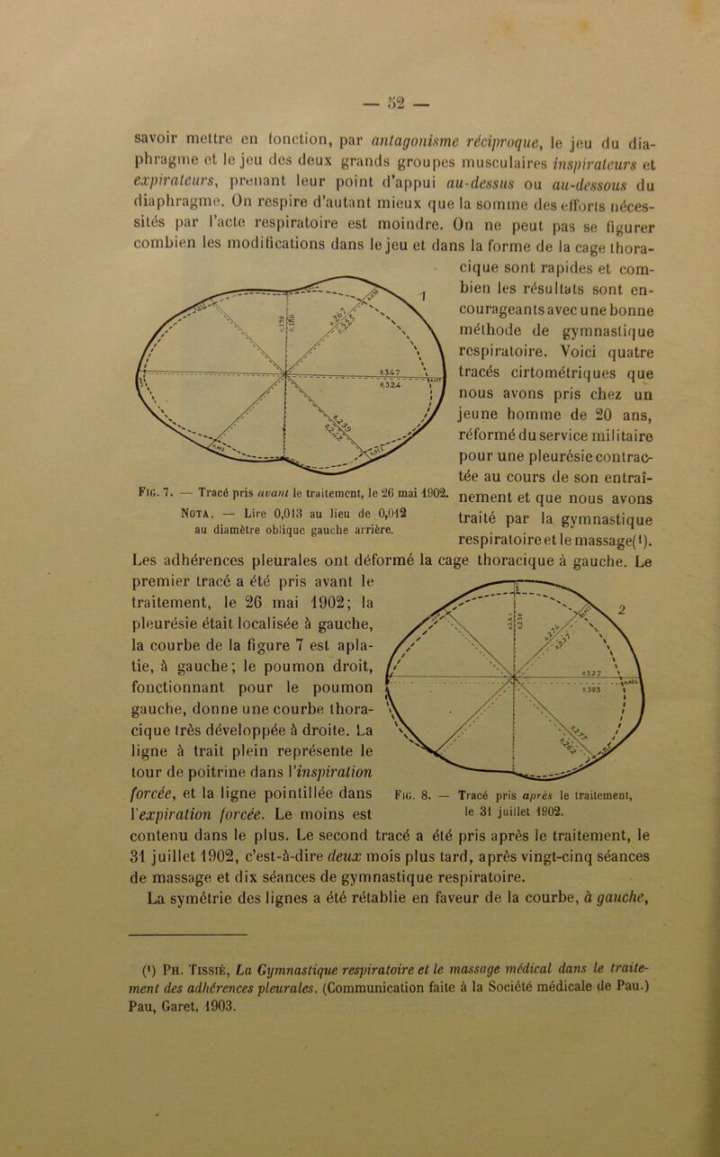 savoir mettre en fonction, par antagonisme réciproque, le jeu du dia- phragme et le jeu des deux grands groupes musculaires inspirateurs et expirateurs, prenant leur point d appui au-dessus ou au-dessous du diaphragme. On respire d autant mieux cjue la somme des efforts néces- sités par l’acte respiratoire est moindre. On ne peut pas se figurer combien les modifications dans le jeu et dans la forme de la cage thora- cique sont rapides et com- bien les résultats sont en- courageants avec une bonne méthode de gymnastique respiratoire. Voici quatre tracés cirtométriques que nous avons pris chez un jeune homme de 20 ans, réformé du service militaire pour une pleurésie contrac- tée au cours de son entraî- Fig. 7. — Tracé pris avant le traitement, le 26 mai 4902. nement et que nous avons Nota. - Lire 0,013 au lieu de 0,042 traité ,a gymnastique au diamètre oblique gauche arrière. ... n respiratoireet le massage(t). Les adhérences pleurales ont déformé la cage thoracique à gauche. Le premier tracé a été pris avant le traitement, le 26 mai 1902; la pleurésie était localisée à gauche, la courbe de la figure 7 est apla- tie, à gauche; le poumon droit, fonctionnant pour le poumon gauche, donne une courbe thora- cique très développée à droite. La ligne à trait plein représente le tour de poitrine dans Yinspiralion forcée, et la ligne pointillée dans l'expiration forcée. Le moins est contenu dans le plus. Le second tracé a été pris après ie traitement, le 31 juillet 1902, c’est-à-dire deux mois plus tard, après vingt-cinq séances de massage et dix séances de gymnastique respiratoire. La symétrie des lignes a été rétablie en faveur de la courbe, à gauche, (*) (*) Ph. Tissié, La Gymnastique respiratoire et le massage médical dans le traite- ment des adhérences pleurales. (Communication faite à la Société médicale de Pau.) Pau, Garet, 1903.