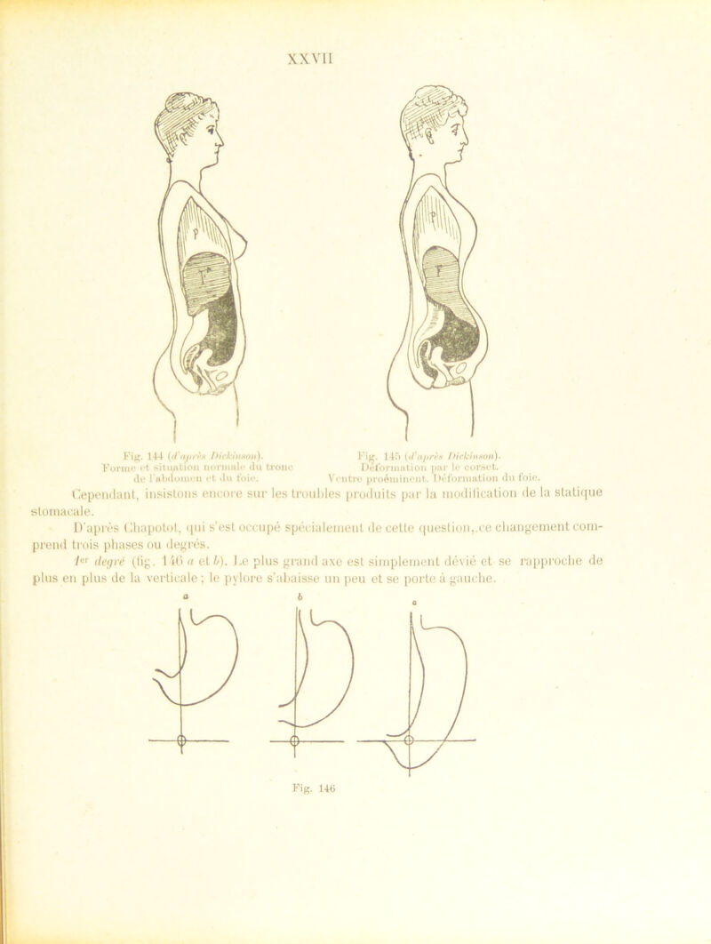 Fig. 144 ((fuprto Dick in son). Fijr. 145 {d'aprP-8 Dickinson). Formc et situation normale du tronc Deformation par le corset. de Fabclomen et du foit\ Ventre proéminent. Défonnation du foie. Cependant, insistons encore sur les trouldes produits par la modification de la statique stomacale. Daprés Cliapotot, *jui s'estoceupé spéeialenienl decetle question,.eechangementcom- prend trois phasesou degres. ier degré (lig. 140 a el l/). he plus grand axe est simplement dévié et se rapproelie de plus en plus de la verticale; le pylore s’abaisse un peu et se porte å gauche. Fig. 146