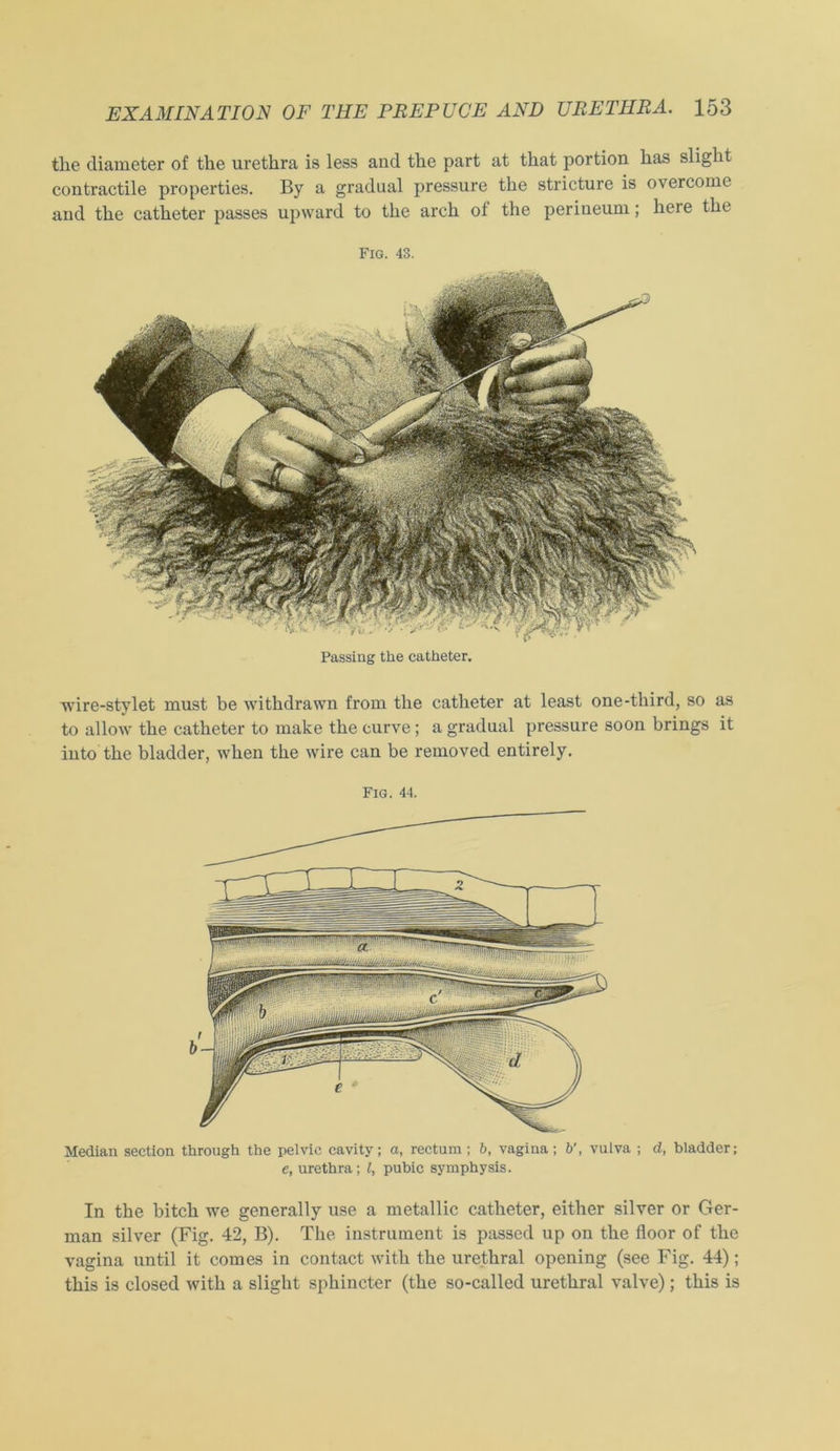 the diameter of tke urethra is less and tke part at that portion lias sliglit contractile properties. By a gradual pressure tke stricture is overcome and tke catketer passes upward to tke arck of tke perineum; kere tke Fig. 43. Passing the catheter. ■wire-stylet must be witkdrawn from tke catketer at least one-tkird, so as to allow tke catketer to make tke curve; a gradual pressure soon brings it iuto tke bladder, wken tke wire can be removed entirely. Fig. 44. Median section through the pelvie cavity; a, rectum; b, vagiua; b', vulva ; d, bladder; e, urethra; l, pubie symphysis. In tke bitck we generally use a metallic catketer, eitker silver or Ger- man silver (Fig. 42, B). Tke instrument is passed up on tke floor of tke vagina until it com es in contact witk tke uretkral opening (see Fig. 44); tkis is closed witk a sliglit spkincter (tke so-called uretkral valve); tkis is