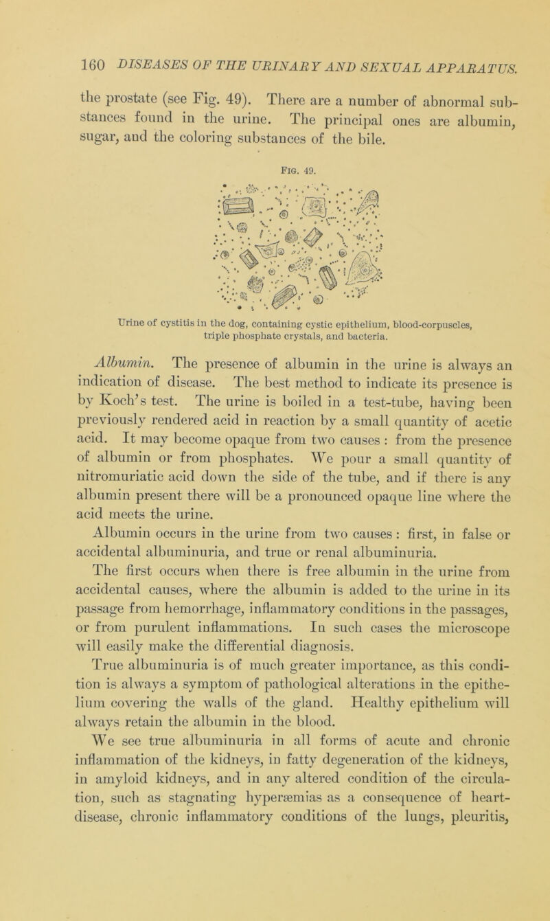 the prostate (see Fig. 49). Tliere are a number of abnormal sub- stances found in the urine. Tlie principal ones are albumin, sogar, aud the coloring substances of the bile. Fig. 49. Urine of cystitis in the dog, containing cystic epithelium, blood-corpuscles, triple phosphate crystals, and bacteria. Albumin. The presence of albumin in the urine is always an indication of disease. The best method to indicate its presence is by Ivoclds test. The urine is boiled in a test-tube, having been previously rendered acid in reaction by a small quantity of acetic acid. It may become opaque from two causes : from the presence of albumin or from phosphates. We pour a small quantity of nitromuriatic acid down the side of the tube, and if there is any albumin present there will be a pronounced opaque line where the acid meets the urine. Albumin occurs in the urine from two causes: first, in false or accidental albuminuria, and true or renal albuminuria. The first occurs when there is free albumin in the urine from accidental causes, where the albumin is added to the urine in its passage from hemorrhage, inflammatory conditions in the passages, or from purulent inflammations. In such cases the microscope will easily make the differential diagnosis. True albuminuria is of much greater importance, as tliis condi- tion is always a Symptom of pathological alterations in the epithe- lium covering the walls of the gland. Healthy epithelium will always retain the albumin in the blood. We see true albuminuria in all forms of acute and chronic inflammation of the kidneys, in fatty degeneration of the kidneys, in amyloid kidneys, and in any altered condition of the circula- tion, such as stagnating hypenemias as a consequence of heart- disease, chronic inflammatory conditions of the lungs, pleuritis,