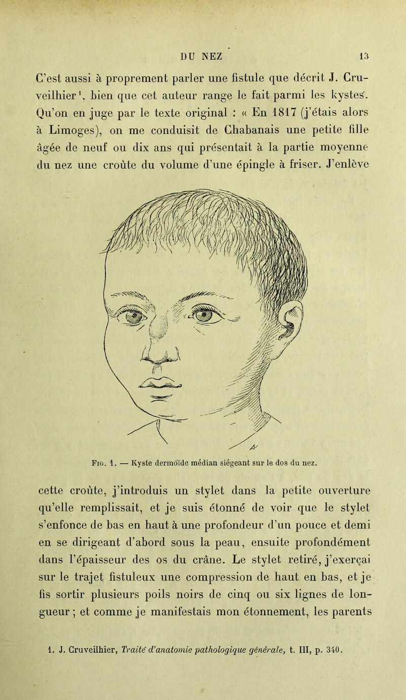 C’est aussi à proprement parler une fistule que décrit J. Cru- veilhier1, bien que cet auteur range le fait parmi les kystes. Qu’on en juge par le texte original : « En 1817 (j’étais alors à Limoges), on me conduisit de Chabanais une petite fille âgée de neuf ou dix ans qui présentait à la partie moyenne du nez une croûte du volume d’une épingle à friser. J’enlève cette croûte, j’introduis un stylet dans la petite ouverture qu’elle remplissait, et je suis étonné de voir que le stylet s’enfonce de bas en haut à une profondeur d’un pouce et demi en se dirigeant d’abord sous la peau, ensuite profondément dans l’épaisseur des os du crâne. Le stylet retiré, j’exerçai sur le trajet fistuleux une compression de haut en bas, et je fis sortir plusieurs poils noirs de cinq ou six lignes de lon- gueur ; et comme je manifestais mon étonnement, les parents 1. J. Cruveilhier, Traite d’anatomie pathologique générale, t. III, p. 340.