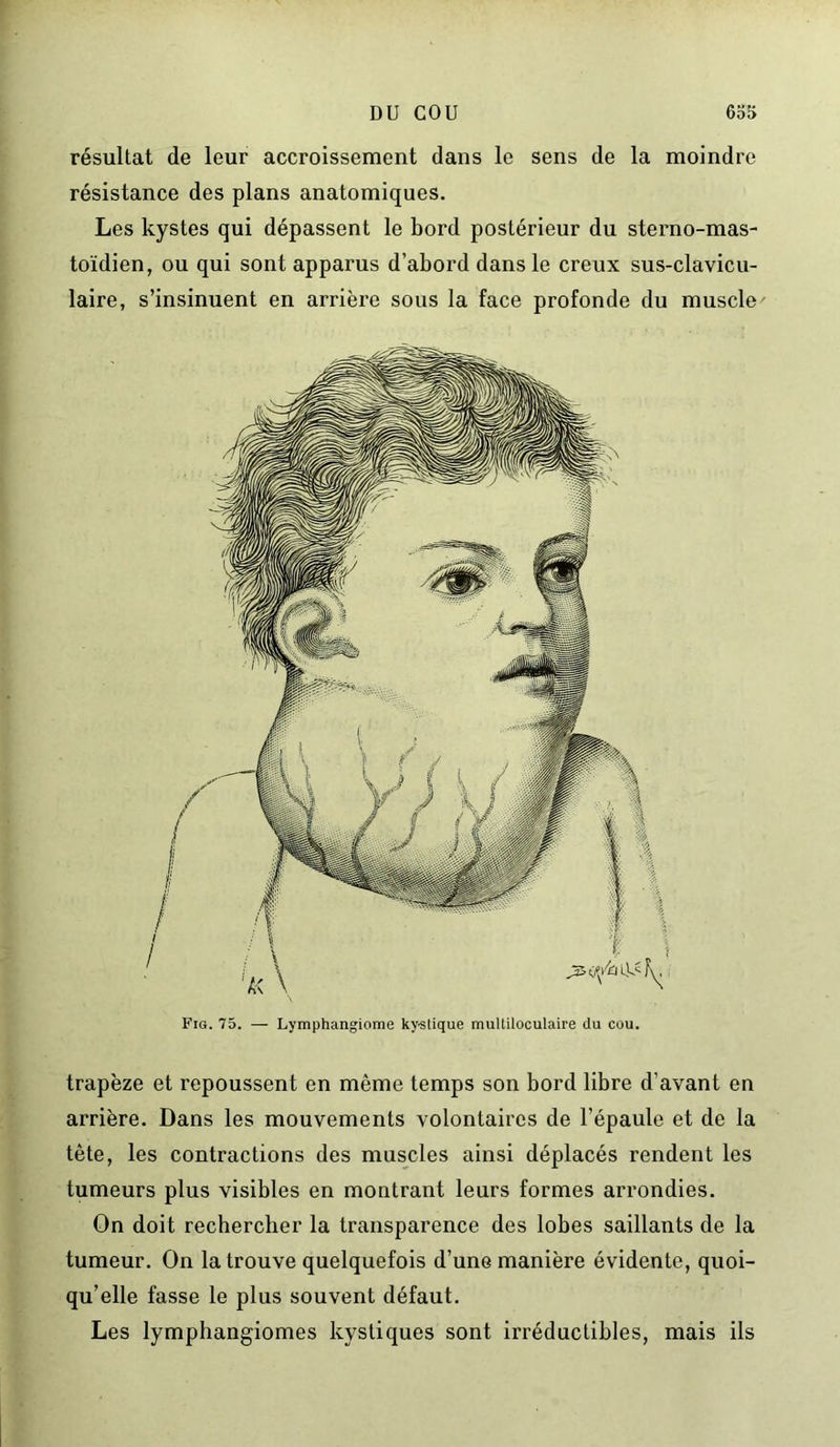 résultat de leur accroissement dans le sens de la moindre résistance des plans anatomiques. Les kystes qui dépassent le bord postérieur du sterno-mas- toïdien, ou qui sont apparus d’abord dans le creux sus-clavicu- laire, s’insinuent en arrière sous la face profonde du muscle trapèze et repoussent en même temps son bord libre d’avant en arrière. Dans les mouvements volontaires de l’épaule et de la tête, les contractions des muscles ainsi déplacés rendent les tumeurs plus visibles en montrant leurs formes arrondies. On doit rechercher la transparence des lobes saillants de la tumeur. On la trouve quelquefois d’une manière évidente, quoi- qu’elle fasse le plus souvent défaut. Les lymphangiomes kystiques sont irréductibles, mais ils Fig. 75. — Lymphangiome ky-slique multiloculaire du cou.