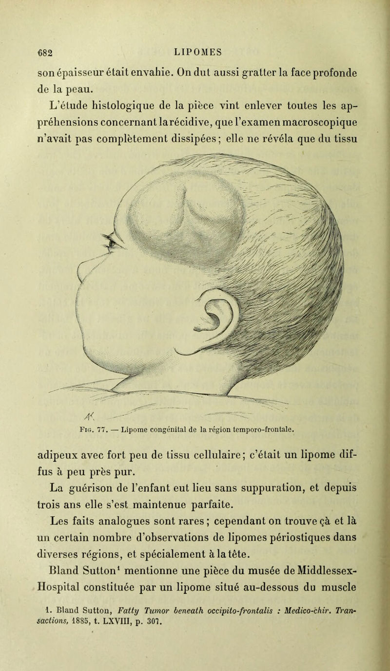 son épaisseur était envahie. On dut aussi gratter la face profonde de la peau. L’étude histologique de la pièce vint enlever toutes les ap- préhensions concernant larécidive, que l’examen macroscopique n’avait pas complètement dissipées; elle ne révéla que du tissu Fig. 77. — Lipome congénital de la région temporo-frontale. adipeux avec fort peu de tissu cellulaire; c’était un lipome dif- fus à peu près pur. La guérison de l’enfant eut lieu sans suppuration, et depuis trois ans elle s’est maintenue parfaite. Les faits analogues sont rares ; cependant on trouve çà et là un certain nombre d’observations de lipomes périostiques dans diverses régions, et spécialement à la tête. Bland Sutton* mentionne une pièce du musée de Middlessex- Hospital constituée par un lipome situé au-dessous du muscle 1. Bland Sutton, Fatty Tumor beneath occipito-frontalis : Medico-chir. Tran- sactions, 1885, t. LXVIII, p. 307.