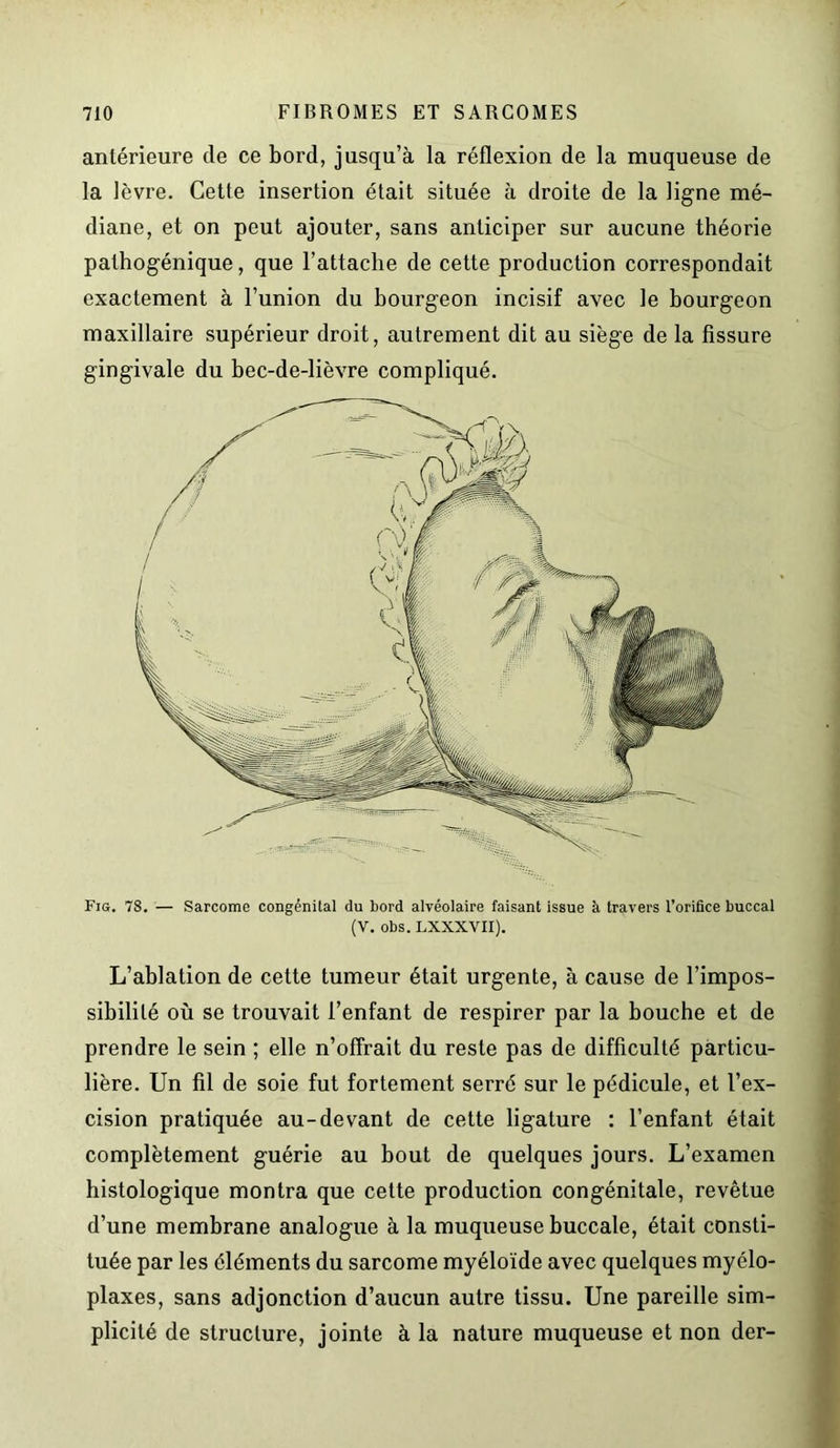 antérieure de ce bord, jusqu’à la réflexion de la muqueuse de la lèvre. Cette insertion était située à droite de la ligne mé- diane, et on peut ajouter, sans anticiper sur aucune théorie pathogénique, que l’attache de cette production correspondait exactement à l’union du bourgeon incisif avec le bourgeon maxillaire supérieur droit, autrement dit au siège de la fissure gingivale du bec-de-lièvre compliqué. Fig. 78. — Sarcome congénilal du bord alvéolaire faisant issue à travers l’orifice buccal (V. obs. LXXXVII). L’ablation de cette tumeur était urgente, à cause de l’impos- sibilité où se trouvait l’enfant de respirer par la bouche et de prendre le sein ; elle n’offrait du reste pas de difficulté particu- lière. Un fil de soie fut fortement serré sur le pédicule, et l’ex- cision pratiquée au-devant de cette ligature : l’enfant était complètement guérie au bout de quelques jours. L’examen histologique montra que cette production congénitale, revêtue d’une membrane analogue à la muqueuse buccale, était consti- tuée par les éléments du sarcome myéloïde avec quelques myélo- plaxes, sans adjonction d’aucun autre tissu. Une pareille sim- plicité de structure, jointe à la nature muqueuse et non der-