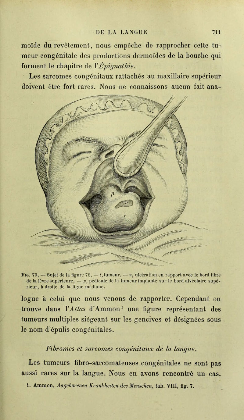 Fig. 79. — Sujet de la figure 78. — l, tumeur. — u, ulcération en rapport avec le bord libre de la lèvre supérieure, —- p, pédicule de la tumeur implanté sur le bord alvéolaire supé- rieur, à droite de la ligne médiane. logue à celui que nous venons de rapporter. Cependant on trouve dans Y Atlas d’Ammon1 une figure représentant des tumeurs multiples siégeant sur les gencives et désignées sous le nom d’épulis congénitales. Fibromes et sarcomes congénitaux de la langue. Les tumeurs fibro-sarcomateuses congénitales ne sont pas aussi rares sur la langue. Nous en avons rencontré un cas. 1. Ammon, Angeborenen Krankheiten des Menschen, tab. VIII, fig. 7. moïde du revêtement, nous empêche de rapprocher cette tu- meur congénitale des productions dermoïdes de la bouche qui forment le chapitre de YÉpignathie. Les sarcomes congénitaux rattachés au maxillaire supérieur doivent être fort rares. Nous ne connaissons aucun fait ana-