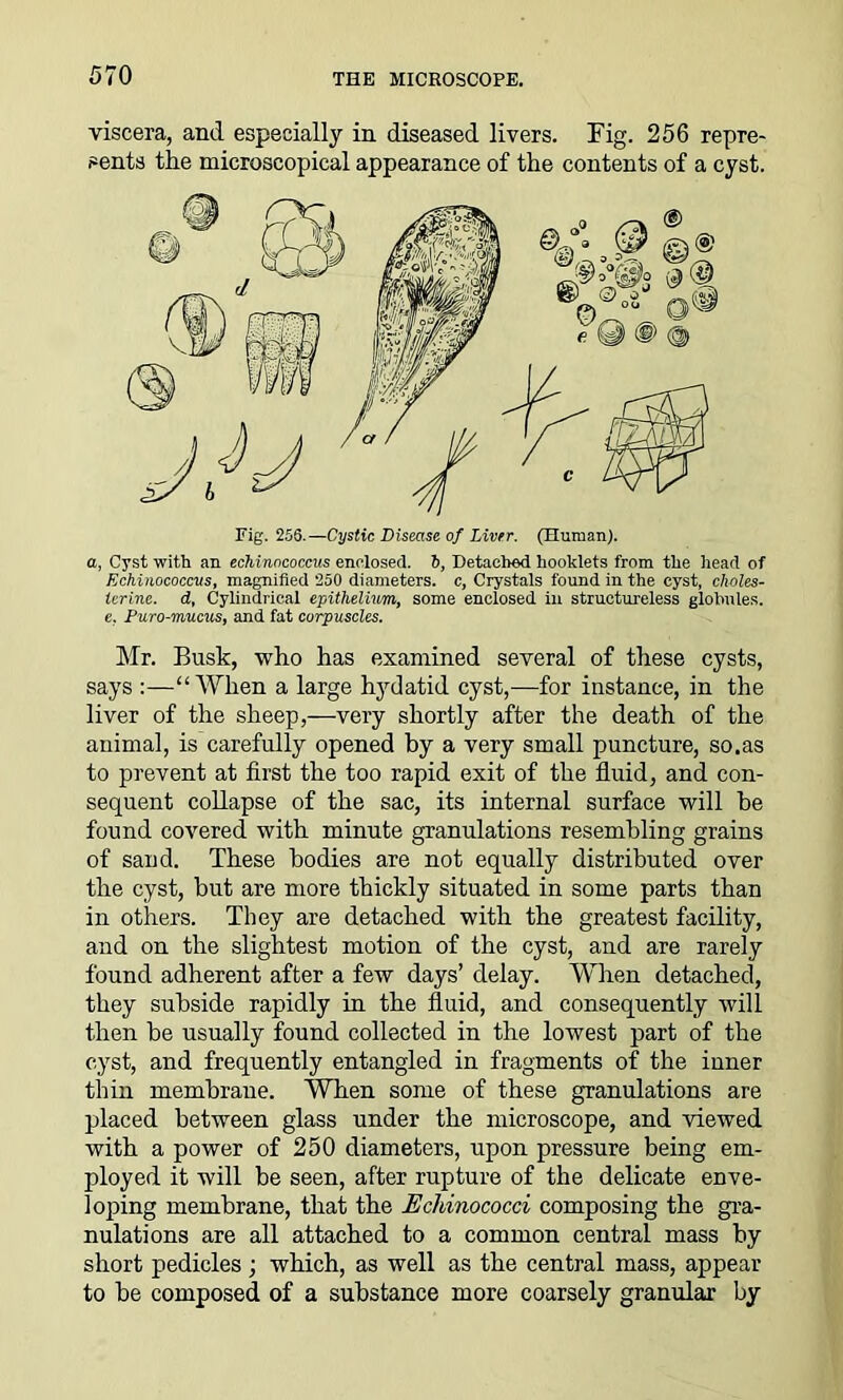 viscera, and especially in diseased livers. Fig. 256 repre- sents the microscopical appearance of the contents of a cyst. a, Cyst with an echinococcus enclosed. S, Detached booklets from the head of Echinococcus, magnified 250 diameters, c, Crystals found in the cyst, choles- lerine. d, Cylindrical epithelium, some enclosed in structureless globules. e, Puro-mucus, and fat corpuscles. Mr. Busk, who has examined several of these cysts, says :—“When a large hydatid cyst,—for instance, in the liver of the sheep,—very shortly after the death of the animal, is carefully opened by a very small puncture, so.as to prevent at first the too rapid exit of the fluid, and con- sequent collapse of the sac, its internal surface will he found covered with minute granulations resembling grains of sand. These bodies are not equally distributed over the cyst, but are more thickly situated in some parts than in others. They are detached with the greatest facility, and on the slightest motion of the cyst, and are rarely found adherent after a few days’ delay. When detached, they subside rapidly in the fluid, and consequently will then be usually found collected in the lowest part of the cyst, and frequently entangled in fragments of the inner thin membrane. When some of these granulations are placed between glass under the microscope, and viewed with a power of 250 diameters, upon pressure being em- ployed it will be seen, after rupture of the delicate enve- loping membrane, that the Echinococci composing the gra- nulations are all attached to a common central mass by short pedicles ; which, as well as the central mass, appear to be composed of a substance more coarsely granular by