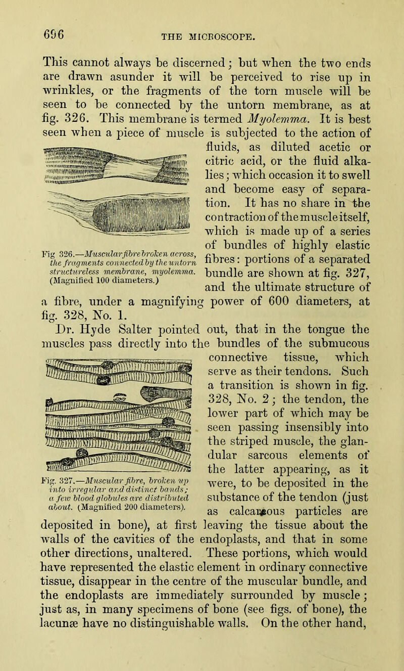 606 This cannot always be discerned; but when the two ends are drawn asunder it will be perceived to rise up in wrinkles, or the fragments of the torn muscle will be seen to be connected by the untorn membrane, as at fig. 326. This membrane is termed Myolemma. It is best seen when a piece of muscle is subjected to the action of fluids, as diluted acetic or citric acid, or the fluid alka- lies ; vrhich occasion it to swell and become easy of separa- tion. It has no share in the contraction of the muscle itself, which is made up of a series of bundles of highly elastic fibres: portions of a separated bundle are shown at fig. 327, and the ultimate structure of ' power of 600 diameters, at Fig 326.—Muscular fibre broken across, the fragments connected by the untorn structureless membrane, myolemma. (Magnified 100 diameters.) a fibre, under a magnifyin fig. 328, No. 1. Dr. Hyde Salter pointed out, that in the tongue the muscles pass directly into the bundles of the submucous connective tissue, which serve as their tendons. Such a transition is shown in fig. 328, No. 2; the tendon, the lower part of which may be seen passing insensibly into the striped muscle, the glan- dular sarcous elements of the latter appearing, as it were, to be deposited in the substance of the tendon (just as calcareous particles are deposited in bone), at first leaving the tissue about the walls of the cavities of the endoplasts, and that in some other directions, unaltered. These portions, which would have represented the elastic element in ordinary connective tissue, disappear in the centre of the muscular bundle, and the endoplasts are immediately surrounded by muscle ; just as, in many specimens of bone (see figs, of bone), the lacunae have no distinguishable walls. On the other hand, -Muscular fibre, broken up ■into irregular and distinct bands; a few blood globules arc distributed about. (Magnified. 200 diameters).