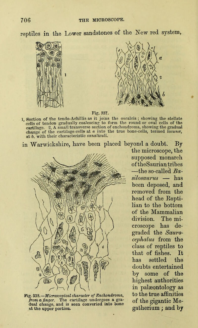 Fig. 337. 1, Section of the tendo-Achillis as it joins the oscalcis ; showing the stellate ’ cells of tendon gradually coalescing to form the round or oval cells of the cartilage. 2, A small transverse section of enchondroma, showing the gradual change of the cartilage-cells at a into the true bone-cells, termed lacuna at 6. *with their characteristic canaliculi. in Warwickshire, have been placed beyond a doubt. By the microscope, the supposed monarch of theSaurian tribes —the so-called Ba- silosaurus — has been deposed, and removed from the head of the Repti- lian to the bottom of the Mammalian division. The mi- croscope has de- graded the Sauro- cephalus from the class of reptiles to that of fishes. It has settled the doubts entertained by some of the highest authorities in palaeontology as Fig. 33S.—Microscopical character of Enchondroma, to the true affinities from a Anger. The cartilage undergoes a gra- 0f cricrantie Mfi- dnal change, and is seen converted into bone ui “ue ploan^ at the upper portion. gathenum j and by