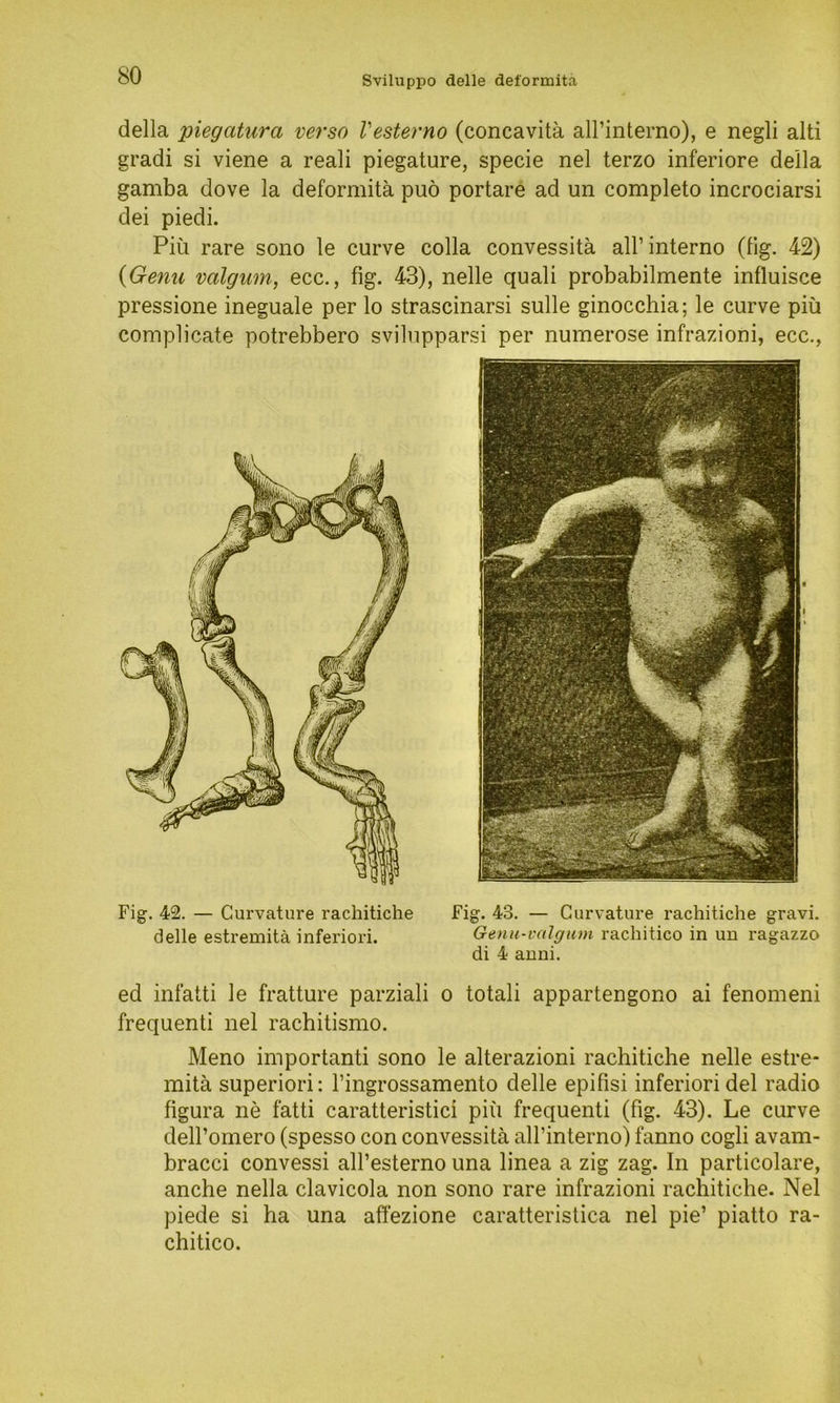 della piegatura verso Vesterno (concavitä all’interno), e negli alti gradi si viene a reali piegature, specie nel terzo inferiore della gamba dove la deformita puö portare ad un completo incrociarsi dei piedi. Piü rare sono le curve colla convessitä aH’interno (tig. 42) {Genu valgum, ecc., fig. 43), nelle quali probabilmente influisce pressione ineguale per lo strascinarsi sulle ginocchia; le curve piü complicate potrebbero svilupparsi per numerose infrazioni, ecc., Fig. 42. — Curvature rachitiche delle estremitä inferiori. Fig. 43. — Curvature rachitiche gravi. Genu-valgum rachitico in un ragazzo di 4 anni. ed infatti le fratture parziali o totali appartengono ai fenomeni frequenti nel rachitismo. Meno importanti sono le alterazioni rachitiche nelle estre- mitä superiori: l’ingrossamento delle epifisi inferiori del radio figura ne fatti caratteristici piü frequenti (fig. 43). Le curve dell’omero (spesso con convessitä all’interno) fanno cogli avam- bracci convessi all’esterno una linea a zig zag. In particolare, anche nella clavicola non sono rare infrazioni rachitiche. Nel piede si ha una affezione caratteristica nel pie’ piatto ra- chitico.