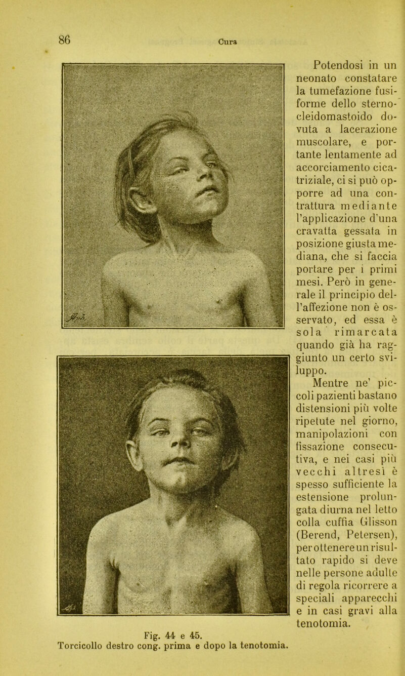 Potendosi in un neonato constatare la tumefazione fusi- forme dello sterno- cleidomastoido do- vuta a lacerazione muscolare, e por- tante lentamente ad accorciamento cica- triziale, ci si puö op- porre ad una con- trattura niediante l’applicazione d'una cravatta gessata in posizione giusta me- diana, che si faccia portare per i primi mesi. Perö in gene- rale il principio del- l’affezione non e os- servato, ed essa e sola rimarcata quando giä ha rag- giunto un certo svi- luppo. Mentre ne’ pic- coli pazienti bastano distensioni piü volte ripetute nel giorno, manipolazioni con fissazione consecu- tiva, e nei casi piü vecchi altresi e spesso sufficiente la estensione prolun- gata diurna nel letto colla cuffia Glisson (Berend, Petersen), perottenereunrisiil- tato rapido si deve nelle persone adulte di regola ricorrere a speciali apparecchi e in casi gravi alla tenotomia. Fig. 44 e 45. Torcicollo destro cong. prima e dopo la tenotomia.