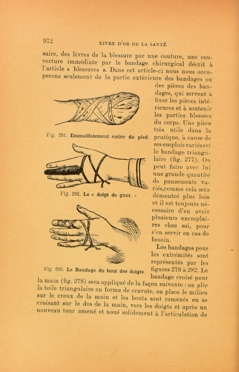 97:3 saire, des levres de la blessure par une couture, une Cou- verture immediate par le bandage chirurgical decrit a 1 article « blessures ». Dans cet article-ci nous nous occu- perons seulenient de la partie exterieure des baudages ou des pieces des ban- dages, qui servent a fixer les pieces inte- rieures et ä soutenir les partics bless^s du corps. Une piece tres utile dans la Fig. 281. Emmaillotement entier du pied. pratique, a cause de ses emplois varies est le bandage triangu- laire (fig. 277). On peilt faire avoc hu une grande quantite de pansements va- rieSjComine cela sera demontre plus loin cessaire d’en avoir plusieurs exemplai- res cbez soi, pour s en servil’ en cas de besoin. Des bandages pour les extremites sont representes par les figures 278 ä 282. Le /£ o-vox f>andage croise pour a mam (fig. 278)_sera apphque de la fafon suivantc ; on pHe la teile triangulaire en forme de eravate, on place le milieu sur le creux de la main et les bouts sont ranienes en se croisant sur le dos de la main, vers les doigts et apres un nouveau tour amene et noue solidement ä l’articulation de I'ig. 283. Le Bandage du bout des doigts.