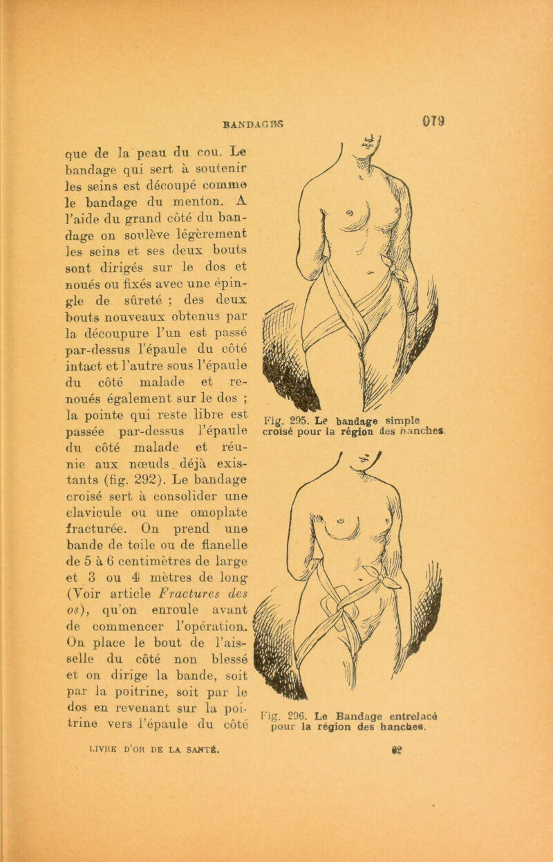 0T9 qiie de la peau du cou. Le bandage qui sert. ä soulenir les seins est decoupe comme le bandage du menton. A Laide du grand cote du ban- dage on souleve legerenient Jes seins et ses deux bouts sont diriges siir le dos et noues ou fixes avec une epin- gle de sürete ; des deux bouts nouveaux obtenus par la decoupure Tun est passe par-dessus l’epaule du cote intact et l’autre sous Tepaule du cote malade et re- noues egalement sur le dos ; la pointe qui reste libre est passee par-dessus l’epaule du cote malade et reu- nie aux noeuds.deja exis- tants (üg. 292). Le bandage croise sert a consolider une clavicule ou une omoplate fracturee. On prend une bande de teile ou de flanelle de 6 ä 6 centimetres de large et 3 ou 4J metres de long (Voir article Fractures des os), qu’on enroule avant de commencer Toperation. Ün place le bout de l’ais- selle du cote non blesse et on dirige la bande, seit par la poitrine, seit par le dos en rcvenant sur la poi- trine vers l’epaule du cote Fig. 295. Le bandage simple crois6 pour la region des hanches. Fig. 296. Le Bandage entrelacd pour la region des hanches. LIVHE D’OR de LA SAKTÄ. 8?