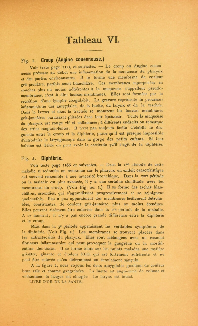 Fig. I. Croup (Angine couenneuse.) Voir texte page 1125 et suivantes. — Le croup ou Angine coueii- neuse presente au debut une Inflammation de la muqueuse du pharynx «t des parties environnantes. II se forme une membrane de couleur gris-jaunätre, parfois aussi blanchätre. Ces membranes superposees en couches plus ou moins adherentes ä la muqueuse s’appellent pseudo- membraues, c’est h dire fausses-membranes. Elles sont formees par la secr^tion d’une lymphe coagulable. La gravure represente le processus inflammatoire des amygdales, de la luette, du larynx et de la trachee. Dans le larynx et dans la trachee se montrent les fausses membranes gris-jaunätres paraissant plissees dans leur epaisseur. Toute la muqueuse du pharynx est rouge vif et enflammee; h. differents endroits on remarque des stries sanguinolentes. II n’est pas toujours facile d’etablir le dia- gnostic entre le croup et la diphterie, parce qu’il est presque impossible d’introduire le laryngoscope dans la gorge des petits enfants. Si leur haieine est fetide on peut avoir la certitude qu’il s’agit de la diphtdrie. Fig. 2. Diphterie. Voir texte page 1166 et suivantes. — Dans la ir« Periode de cette maladie si redoutee on remarque sur le pharynx un enduit caracteristique qui souvent ressemble ä une mucosite bronchique. Dans la 2™« Periode ou la maladie est plus avancee, il y a une certaine similitude avec les membranes du croup. (Voir Fig. no. l.) II se forme des taches blan- chatres, arrondies, qui s’agrandissent progressivement et se rejoignent quelquefois. Peu a peu apparaissent des membranes facilement detacha- bles, consistantes, de couleur gris-jaunatre, plus ou moins etendues. Elles peuvent ais^ment Stre enlevees dans la ire periode de la maladie. A ce moment, il n’y a pas encore grande difference entre la diphterie et le croup. Mais dans la 3« Periode apparaissent les v^ritables symptomes de la diphterie. (Voir Fig. 2.) Les membranes se trouvent placees dans les anfractuosites du pharynx. Elles sont melangees avec un exsudat fibrineux inflammatoire qui peut provoquer la gangr^ne ou la mortifi- cation des tissus. Il se forme alors sur les points malades une m.atiere grisdtre, gluante et d’odeur fetide qui est fortement adherente et ne peut etre enlevee qu’en döterminant un ^coulement sanguin. A la figure 2, nous voyons les deux amygdales gonflees, de couleur brun sale et comme gangren^es. La luette est augmentee de volume et enflammee; la langue est chargee. I-e larynx est intact. I.TVR£ D’OR DF. LA SANTF.