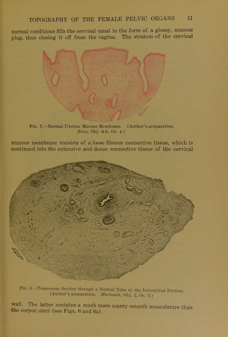 normal conditions fills the cervical canal in the form of a glossy, mucous plug, thus closing it off from the vagina. The stratum of the cervical FlG. 7.—Normal Uterine Mucous Membrane. (Author’s preparation. Zeiss, Obj. AA, Oc. 4.) mucous membrane consists of a loose fibrous connective tissue, which is continued into the extensive and dense connective tissue of the cervical Fig. 8. Transverse Section through a Normal Tube at the Interstitial Portion. (Author’s preparation. Hartymck, Obj. 2, Oc. 3.) wall. The latter contains a much more scanty smooth musculature than the corpus uteri (see Figs. 6 and 6a).