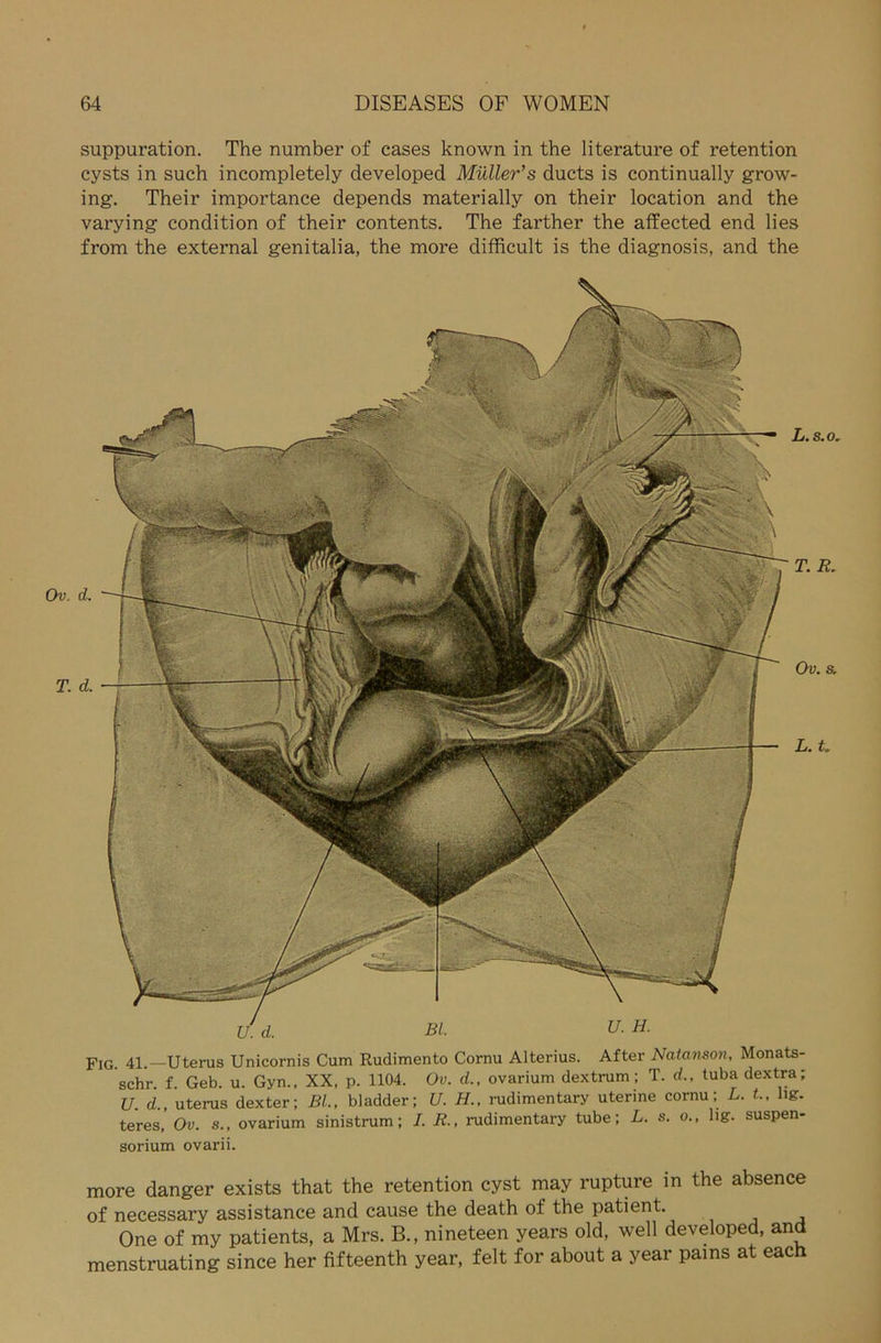 suppuration. The number of cases known in the literature of retention cysts in such incompletely developed Müller’s ducts is continually grow- ing. Their importance depends materially on their location and the varying condition of their contents. The farther the affected end lies from the external genitalia, the more difficult is the diagnosis, and the FlG. 41.—Uterus Unicornis Cum Rudimento Cornu Alterius. After Natanson, Monats- schr. f. Geb. u. Gyn., XX, p. 1104. Ov. d., ovarium dextrum ; T. d,, tuba dextra; U. d., uterus dexter; BL, bladder; U. H., rudimentary uterine cornu; L. t., hg. teres, Ov. s., ovarium sinistrum; I. R., rudimentary tube; L. s. o., hg. Suspen- sorium ovarii. more danger exists that the retention cyst may rupture in the absence of necessary assistance and cause the death of the patient, One of my patients, a Mrs. B., nineteen years old, well developed, and menstruating since her fifteenth year, feit for about a year pains at each