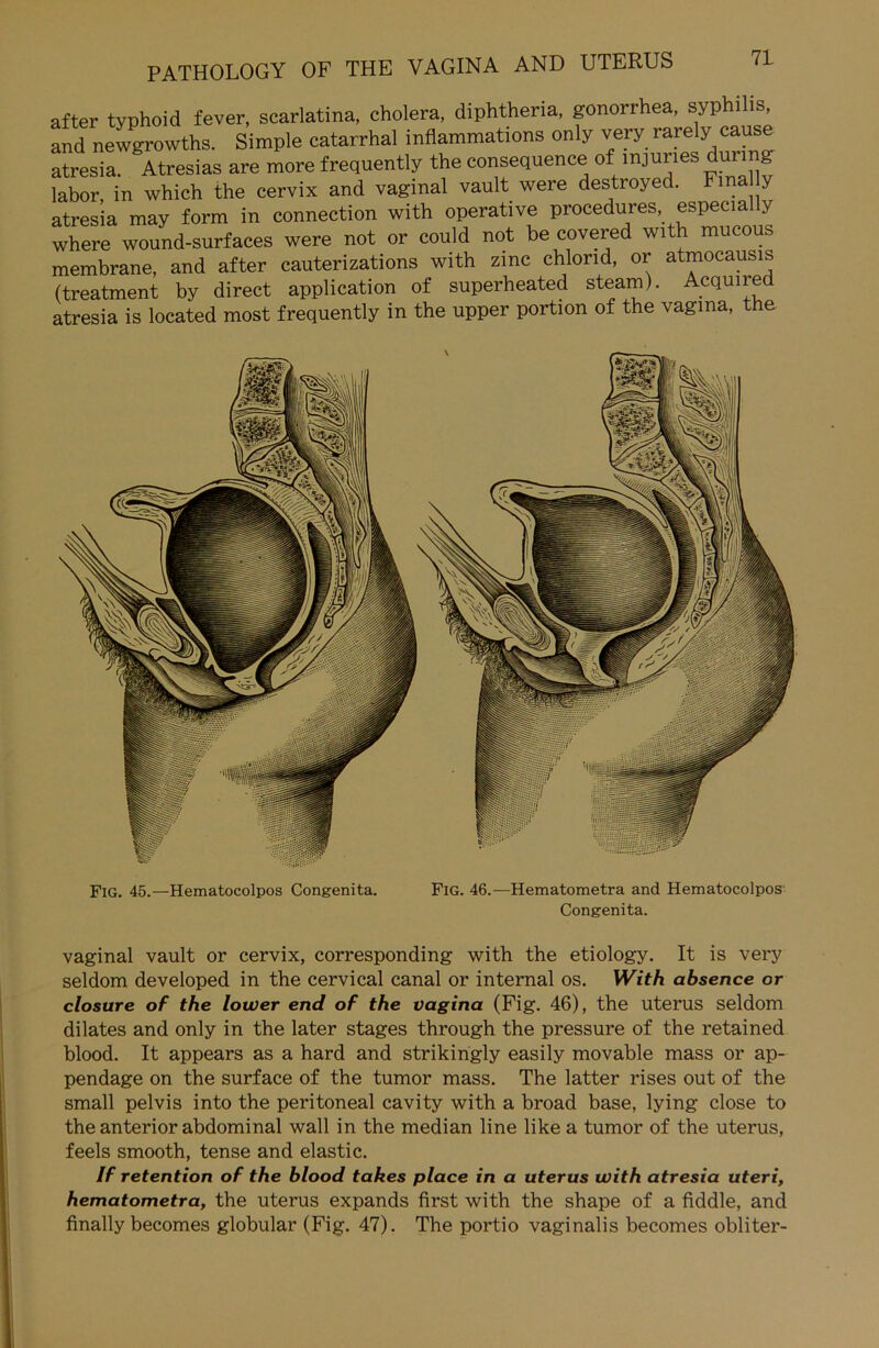 after typhoid fever, scarlatina, cholera, diphtheria, gonorrhea, syphilis, and newgrowths. Simple catarrhal inflammations only very rarely cause atresia. Atresias are more frequently the consequence of mjuries durmg labor in which the cervix and vaginal vault were destroyed. Fma y atresia may form in connection with operative procedures especially where wound-surfaces were not or could not be covered with mucoub membrane, and after cauterizations with zinc chlorid, or atmocausis (treatment by direct application of superheated steam). Acquire atresia is located most frequently in the upper portion of the vagina, the Fig. 45.—Hematocolpos Congenita. FlG. 46.—Hematometra and Hematocolpos Congenita. vaginal vault or cervix, corresponding with the etiology. It is very seldom developed in the cervical canal or internal os. With absence or closure of the lower end of the vagina (Fig. 46), the uterus seldom dilates and only in the later stages through the pressure of the retained blood. It appears as a hard and strikingly easily movable mass or ap- pendage on the surface of the tumor mass. The latter rises out of the small pelvis into the peritoneal cavity with a broad base, lying close to the anterior abdominal wall in the median line like a tumor of the uterus, feels smooth, tense and elastic. If retention of the blood takes place in a uterus with atresia uteri, hematometra, the uterus expands first with the shape of a fiddle, and finally becomes globular (Fig. 47). The portio vaginalis becomes obliter-