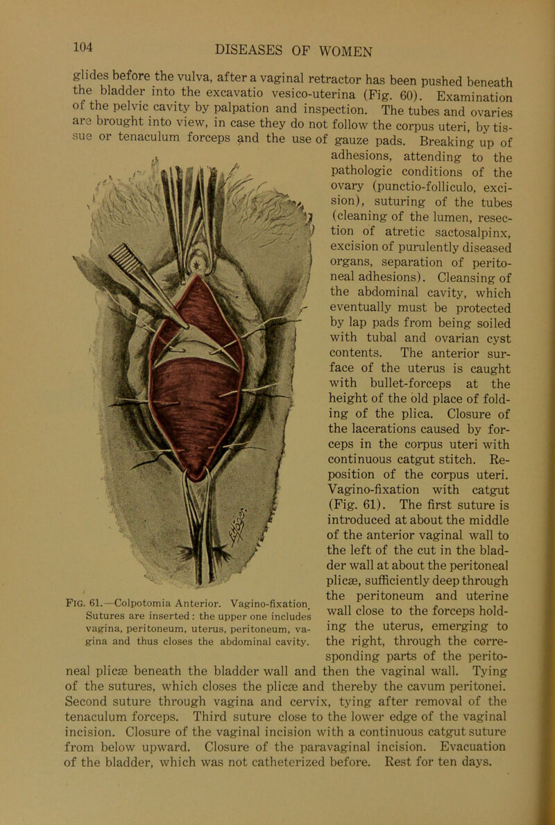 glides before the vulva, after a vaginal retractor has been pushed beneath the bladder into the excavatio vesico-uterina (Fig. 60). Examination of the pelvic cavity by palpation and inspection. The tubes and ovaries are brought into view, in case they do not follow the corpus uteri, by tis- sue or tenaculum forceps and the use of gauze pads. Breaking up of adhesions, attending to the Pathologie conditions of the ovary (pnnctio-folliculo, exci- sion), suturing of the tubes (cleaning of the lumen, resec- tion of atretic sactosalpinx, excision of purulently diseased Organs, Separation of perito- neal adhesions). Cleansing of the abdominal cavity, which eventually must be protected by lap pads from being soiled with tubal and ovarian cyst contents. The anterior sur- face of the uterus is caught with bullet-forceps at the height of the old place of fold- ing of the plica. Closure of the lacerations caused by for- ceps in the corpus uteri with continuous catgut stitch. Re- position of the corpus uteri. Vagino-fixation with catgut (Fig. 61). The first suture is introduced at about the middle of the anterior vaginal wall to the left of the cut in the blad- der wall at about the peritoneal plicas, sufficiently deep through the peritoneum and uterine wall close to the forceps hold- ing the uterus, emerging to the right, through the corre- sponding parts of the perito- neal plicae beneath the bladder wall and then the vaginal wall. Tying of the sutures, which closes the plicas and thereby the cavum peritonei. Second suture through vagina and cervix, tying after removal of the tenaculum forceps. Third suture close to the lower edge of the vaginal incision. Closure of the vaginal incision with a continuous catgut suture from below upward. Closure of the paravaginal incision. Evacuation of the bladder, which was not catheterized before. Rest for ten days. Fig. 61.—Colpotomia Anterior. Vagino-fixation, Sutures are inserted: the upper one includes vagina, peritoneum, uterus, peritoneum, va- gina and thus closes the abdominal cavity.