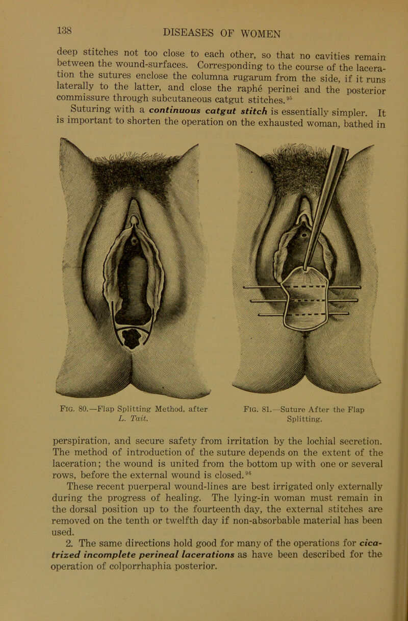 deep stitches not too close to each other, so that no cavities remain between the wound-surfaces. Corresponding to the course of the lacera- tion the sutures enclose the columna rugarum from the side, if it runs laterally to the latter, and close the raphe perinei and the posterior commissure through subcutaneous catgut stitches.95 Suturing with a continuous catgut stitch is essentially simpler. It is important to shorten the Operation on the exhausted woman, bathed in Fig. 80.—Flap Splitting Method, after L. Tait. Fig. 81.—Suture After the Flap Splitting. perspiration, and secure safety from irritation by the lochial secretion. The method of introduction of the suture depends on the extent of the laceration; the wound is united from the bottom up with one or several rows, before the external wound is closed.96 These recent puerperal wound-lines are best irrigated only externally during the progress of healing. The lying-in woman must remain in the dorsal Position up to the fourteenth day, the external stitches are removed on the tenth or twelfth day if non-absorbable material has been used. 2. The same directions hold good for many of the operations for cica- trized incomplete perineal lacerations as have been described for the Operation of colporrhaphia posterior.