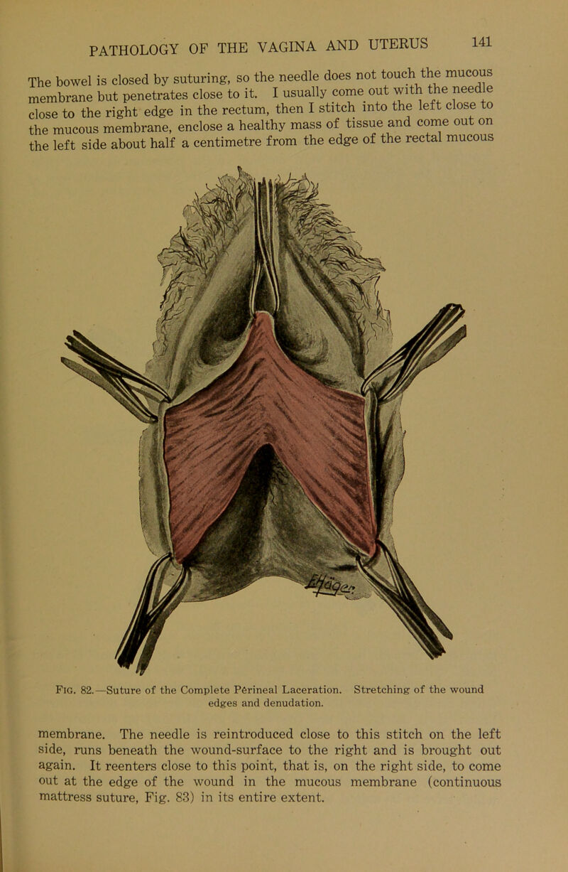 The bowel is closed by suturing, so the needle does not touch the mucous membrane but penetrates close to it. I usually come out with the needle close to the right edge in the rectum, then I stitch mto the left close to the mucous membrane, enclose a healthy mass of tissue and come out on the left side about half a centimetre from the edge of the rectal mucous FlG. 82.—Suture of the Complete Perineal Laceration. Stretching of the wound edges and denudation. membrane. The needle is reintroduced close to this stitch on the left side, runs beneath the wound-surface to the right and is brought out again. It reenters close to this point, that is, on the right side, to come out at the edge of the wound in the mucous membrane (continuous mattress suture, Fig. 83) in its entire extent.