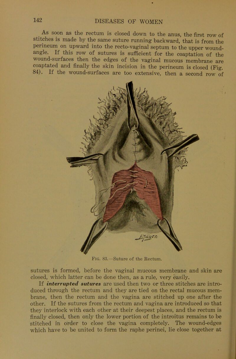 . As soon as the rectum is closed down to the anus, the first row of stitches is made by the same suture running backward, that is from the perineum on upward into the recto-vaginal septum to the upper wound- angle. If this row of sutures is sufficient for the coaptation of the wound-surfaces then the edges of the vaginal mucous membrane are coaptated and finally the skin incision in the perineum is closed (Fig. 84). If the wound-surfaces are too extensive, then a second row of Fig. 83.—Suture of the Rectum. sutures is formed, before the vaginal mucous membrane and skin are closed, which latter can be done then, as a rule, very easily. If interrupted sutures are used then two or three stitches are intro- duced through the rectum and they are tied on the rectal mucous mem- brane, then the rectum and the vagina are stitched up one after the other. If the sutures from the rectum and vagina are introduced so that they interlock with each other at their deepest places, and the rectum is finally closed, then only the lower portion of the introitus remains to be stitched in order to close the vagina completely. The wound-edges which have to be united to form the raphe perinei, lie close together at