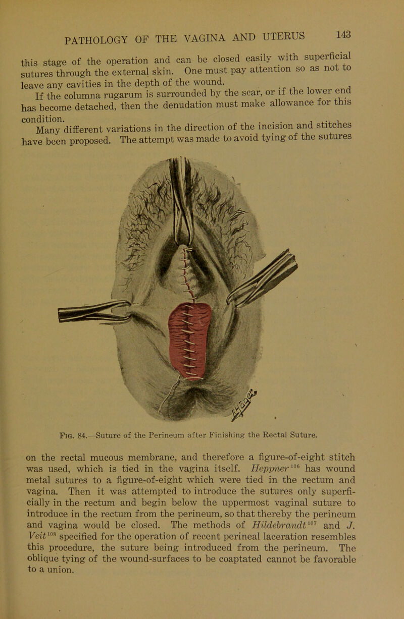 this stage of the Operation and can be closed easily with superficial sutures through the external skin. One must pay attention so as not to leave any cavities in the depth of the wound. , If the columna rugarum is surrounded by the scar, or lf the lower end has become detached, then the denudation must make allowance for this condition. „ , . . . , ... , Many different variations in the direction of the incision and stitches have been proposed. The attempt was made to avoid tying of the sutures Fig. 84.—Suture of the Perineum after Finishing the Rectal Suture. on the rectal mucous membrane, and therefore a figure-of-eight stitch was used, which is tied in the vagina itself. Heppner106 has wound metal sutures to a figure-of-eight which were tied in the rectum and vagina. Then it was attempted to introduce the sutures only superfi- cially in the rectum and begin below the uppermost vaginal suture to introduce in the rectum from the perineum, so that thereby the perineum and vagina would be closed. The methods of Hildebrandt107 and J. Veit108 specified for the Operation of recent perineal laceration resembles this procedure, the suture being introduced from the perineum. The oblique tying of the wound-surfaces to be coaptated cannot be favorable to a Union.