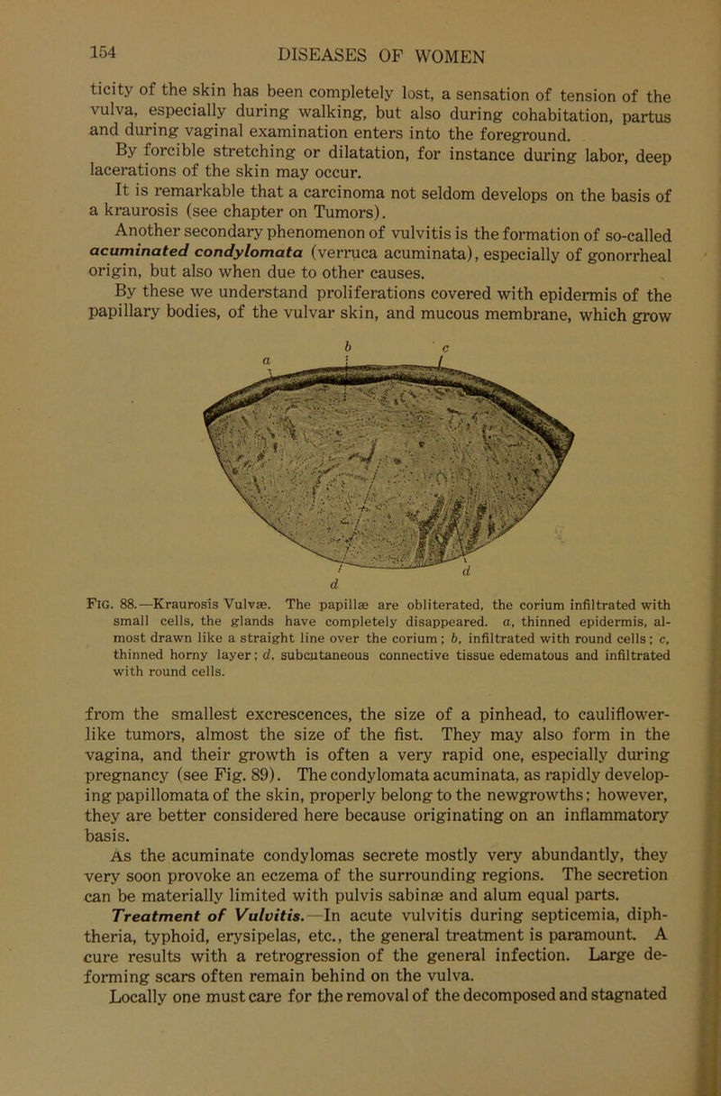 ticity of the skin has been completely lost, a Sensation of tension of the vulva, especially during walking, but also during cohabitation, partus and during vaginal examination enters into the foreground. By forcible Stretching or dilatation, for instance during labor, deep lacerations of the skin may occur. It is remarkable that a carcinoma not seldom develops on the basis of a kraurosis (see chapter on Tumors). Another secondary phenomenon of vulvitis is the formation of so-called acuminated condylomata (verruca acuminata), especially of gonorrheal origin, but also when due to other causes. By these we understand proliferations covered with epidermis of the papillary bodies, of the vulvar skin, and mucous membrane, which grow b ■ c FlG. 88.—Kraurosis Vulvas. The papillae are obliterated, the corium infiltrated with small cells, the giands have completely disappeared. a, thinned epidermis, al- most drawn like a straight line over the corium; b, infiltrated with round cells; c, thinned horny layer; d, subcutaneous connective tissue edematous and infiltrated with round cells. from the smallest excrescences, the size of a pinhead, to cauliflower- like tumors, almost the size of the fist. They may also form in the vagina, and their growth is often a very rapid one, especially during pregnancy (see Fig. 89). The condylomata acuminata, as rapidly develop- ing papillomata of the skin, properly belong to the newgrowths; however, they are better considered here because originating on an inflammatory basis. As the acuminate condylomas secrete mostly very abundantly, they very soon provoke an eczema of the surrounding regions. The secretion can be materially limited with pulvis sabinae and alum equal parts. Treatment of Vulvitis.—In acute vulvitis during septicemia, diph- theria, typhoid, erysipelas, etc., the general treatment is paramount. A eure results with a retrogression of the general infection. Large de- forming scars often remain behind on the vulva. Locally one must care for the removal of the decomposed and stagnated