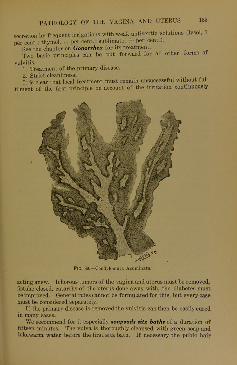 secretion by frequent irrigations with weak antiseptic Solutions (lysol, 1 per cent.; thymol, iV Per cent.; Sublimate, Y<t Per cent.). See the chapter on Gonorrhea for its treatment. Two basic principles can be put forward for all other forms of vulvitis. 1. Treatment of the primary disease. 2. Strict cleanliness. It is clear that local treatment must remain unsuccessful without lul- filment of the first principle on account of the irritation continuously Fig. 89.—Condylomata Acuminata. acting anew. Ichorous tumors of the vagina and uterus must be removed, fistulse closed, catarrhs of the uterus done away with, the diabetes must be improved. General rules cannot be formulated for this, but every case must be considered separately. If the primary disease is removed the vulvitis can then be easily cured in many cases. We recommend for it especially soapsuds sitz baths of a duration of fifteen minutes. The vulva is thoroughly cleansed with green soap and lukewarm water before the first sitz bath. If necessary the pubic hair