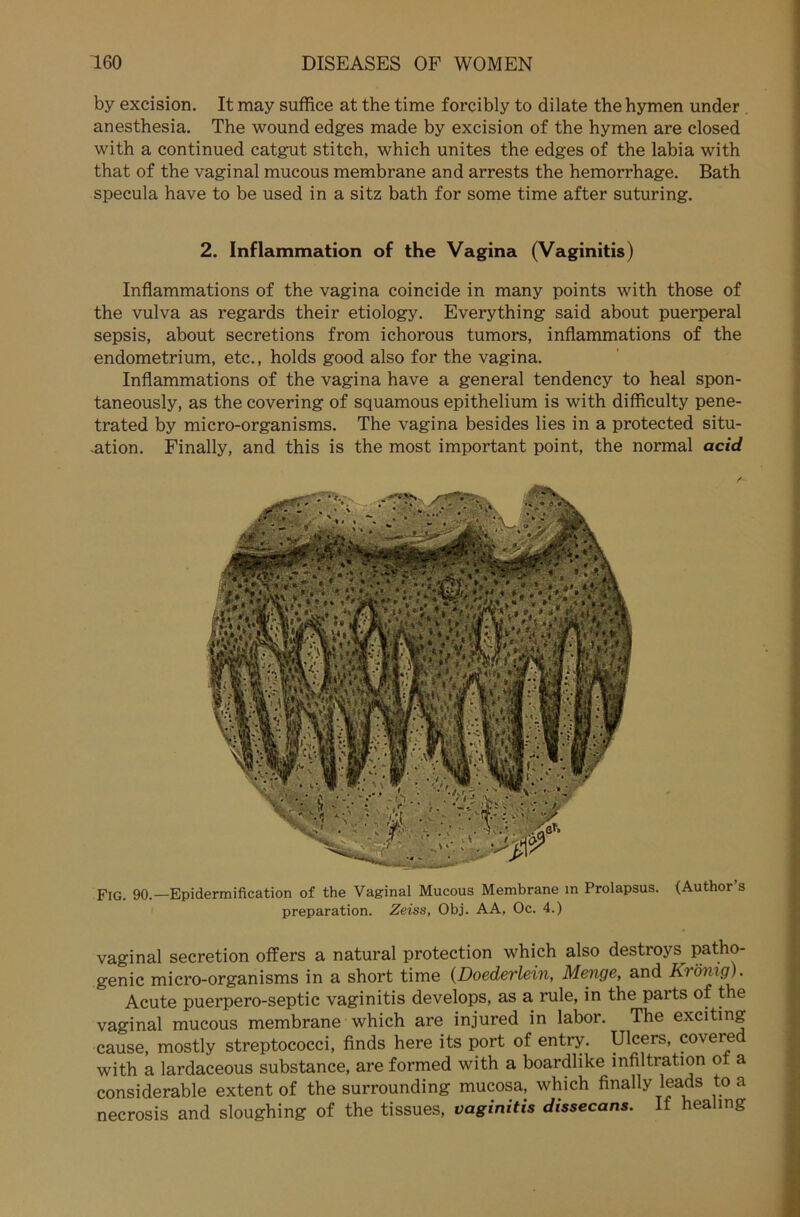 by excision. It may suffice at the time forcibly to dilate thehymen under anesthesia. The wound edges made by excision of the hymen are closed with a continued catgut stitch, which unites the edges of the labia with that of the vaginal mucous membrane and arrests the hemorrhage. Bath specula have to be used in a sitz bath for some time after suturing. 2. Inflammation of the Vagina (Vaginitis) Inflammations of the vagina coincide in many points with those of the vulva as regards their etiology. Everything said about puerperal sepsis, about secretions from ichorous tumors, inflammations of the endometrium, etc., holds good also for the vagina. Inflammations of the vagina have a general tendency to heal spon- taneously, as the covering of squamous epithelium is with difficulty pene- trated by micro-organisms. The vagina besides lies in a protected Situ- ation. Finally, and this is the most important point, the normal acid Fig. 90.—Epidermification of the Vaginal Mucous Membrane in Prolapsus. (Author s preparation. Zeiss, Obj. AA, Oc. 4.) vaginal secretion offers a natural protection which also destroys^ patho- genic micro-organisms in a short time (Doederlein, Menge, and Krönig). Acute puerpero-septic vaginitis develops, as a rule, in the parts of the vaginal mucous membrane which are injured in labor. The exciting cause, mostly Streptococci, finds here its port of entry. Ulcers, coveied with a lardaceous substance, are formed with a boardlike infiltration ot a considerable extent of the surrounding mucosa, which finally leads to a necrosis and sloughing of the tissues, vaginitis dissecans. If healing