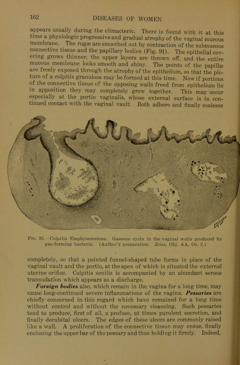 appears usually during the climacteric. There is found with it at this time a Physiologie progressive and gradual atrophyof the vaginal mucous membrane. The rüg* are smoothed out by contraction of the submucous connective tissue and the papillary bodies (Fig. 91). The epithelial cov- ering grows thinner, the upper layers are thrown off, and the entire mucous membrane looks smooth and shiny. The points of the papill* are freely exposed through the atrophy of the epithelium, so that the pic- ture of a colpitis granulosa may be formed at this time. Now if portions of the connective tissue of the opposing walls freed from epithelium lie in apposition they may completely grow together. This may occur especially at the portio vaginalis, whose external surface is in con- ti nued contact with the vaginal vault. Both adhere and finally coalesce Fig. 92.—Colpitis Emphysematosa. Gaseous cysts in the vaginal walls produced by gas-forming bacteria. (Author’s preparation. Zeiss, Obj. AA, Oc. 2.) % completely, so that a pointed funnel-shäped tube forms in place of the vaginal vault and the portio, at theapex of which is situated the external uterine orifice. Colpitis senilis is accompanied by an abundant serous transudation which appears as a discharge. Foreign bodies also, which remain in the vagina for a long time, may cause long-continued severe infiammations of the vagina. Pessaries are chiefly concerned in this regard which have remained for a long time without control and without the necessary cleansing. Such pessaries tend to produce, first of all, a profuse, at times purulent secretion, and finally decubital ulcers. The edges of these ulcers are commonly raised like a wall. A proliferation of the connective tissue may ensue, finally enclosing the upper bar of the pessary and thus holdi ng i t firmly. Indeed,
