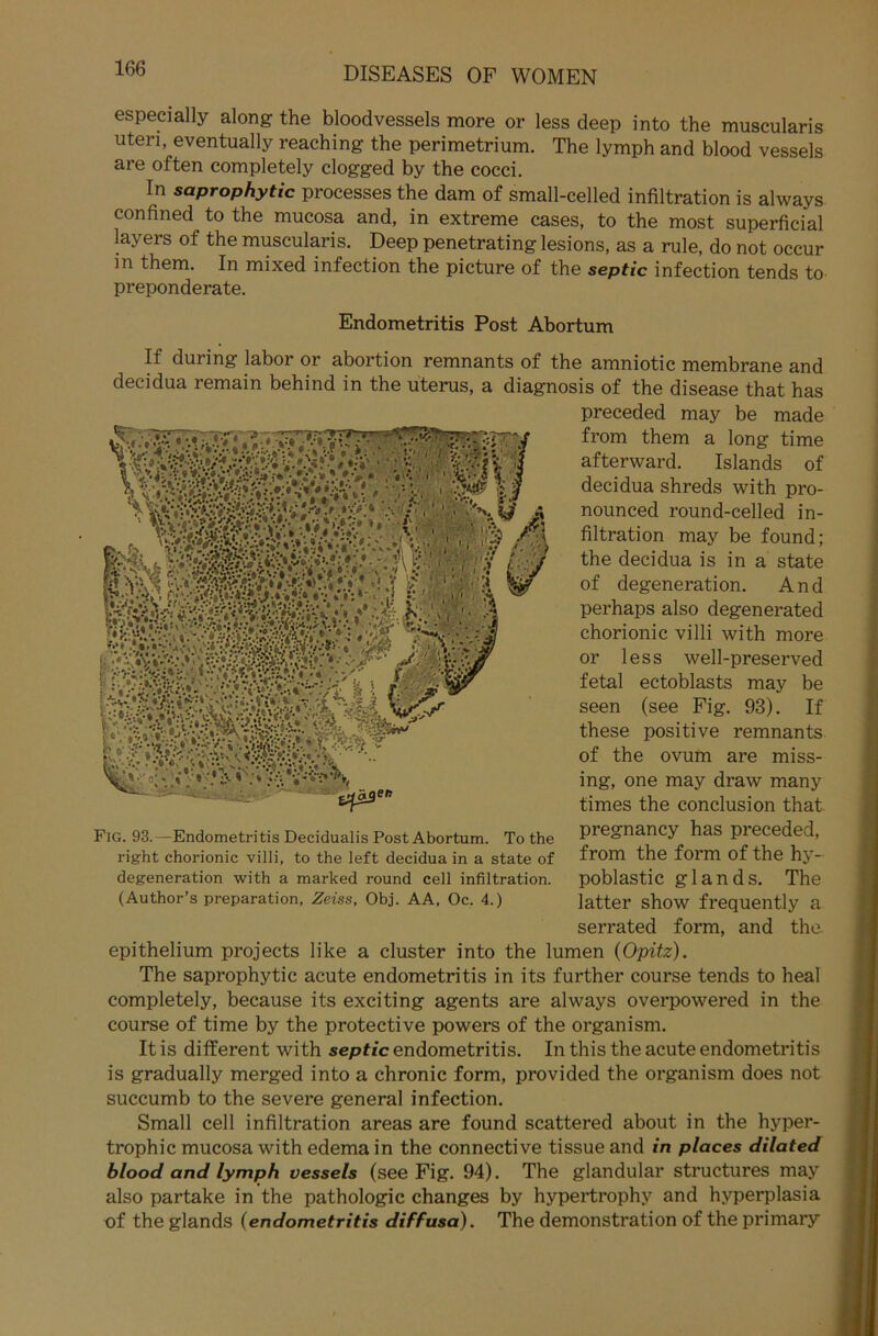 especially along the bloodvessels more or less deep into the muscularis Uten, eventually reaching the perimetrium. The lymph and blood vessels are often completely clogged by the cocci. In saprophytic processes the dam of small-celled infiltration is always confined to the mucosa and, in extreme cases, to the most superficial layers of the muscularis. Deep penetrating lesions, as a rule, do not occur in them. In mixed infection the picture of the septic infection tends to preponderate. Endometritis Post Abortum If during labor or abortion remnants of the amniotic membrane and decidua remain behind in the uterus, a diagnosis of the disease that has preceded may be made from them a long time afterward. Islands of decidua shreds with pro- nounced round-celled in- filtration may be found; the decidua is in a state of degeneration. And perhaps also degenerated chorionic villi with more or less well-preserved fetal ectoblasts may be seen (see Fig. 93). If these positive remnants of the ovum are miss- ing, one may draw many times the conclusion that pregnancy has preceded, from the form of the hy- poblastic glands. The latter show frequently a serrated form, and the epithelium projects like a cluster into the lumen (Opitz). The saprophytic acute endometritis in its further course tends to heal completely, because its exciting agents are always overpowered in the course of time by the protective powers of the organism. It is different with septic endometritis. In this the acute endometritis is gradually merged into a chronic form, provided the organism does not succumb to the severe general infection. Small cell infiltration areas are found scattered about in the hyper- trophic mucosa with edema in the connective tissue and in places dilated blood and lymph vessels (see Fig. 94). The glandular structures may also partake in the pathologic changes by hypertroph.v and hvperplasia of the glands (endometritis diffusa). The demonstration of the primary Fig. 93.—Endometritis Decidualis Post Abortum. To the right chorionic villi, to the left decidua in a state of degeneration with a marked round cell infiltration. (Author’s preparation, Zeiss, Obj. AA, Oc. 4.)