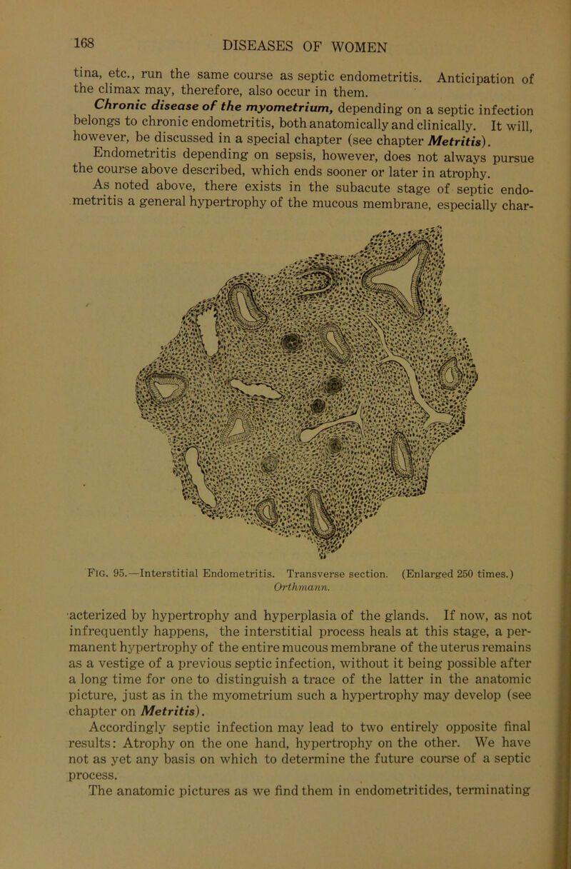 tina, etc., run the same course as septic endometritis. Anticipation of the climax may, therefore, also occur in them. Chronic disease of the myometrium, depending on a septic infection belongs to chronic endometritis, both anatomically and clinically. It will, however, be discussed in a special chapter (see chapter Metritis). Endometritis depending on sepsis, however, does not always pursue the course above described, which ends sooner or later in atrophy. As noted above, there exists in the subacute stage of septic endo- metritis a general hypertrophy of the mucous membrane, especially char- Fig. 95.—Interstitial Endometritis. Transverse section. (Enlarged 250 times.) Orthmann. acterized by hypertrophy and hyperplasia of the glands. If now, as not infrequently happens, the interstitial process heals at this stage, a per- manent hypertrophy of the entire mucous membrane of the Uterus remains as a vestige of a previous septic infection, without it being possible after a long time for one to distinguish a trace of the latter in the anatomic picture, just as in the myometrium such a hypertrophy may develop (see chapter on Metritis). Accordingly septic infection may lead to two entirely opposite final results: Atrophy on the one hand, hypertrophy on the other. We have not as yet any basis on which to determine the future course of a septic process. The anatomic pictures as we find them in endometritides, terminating