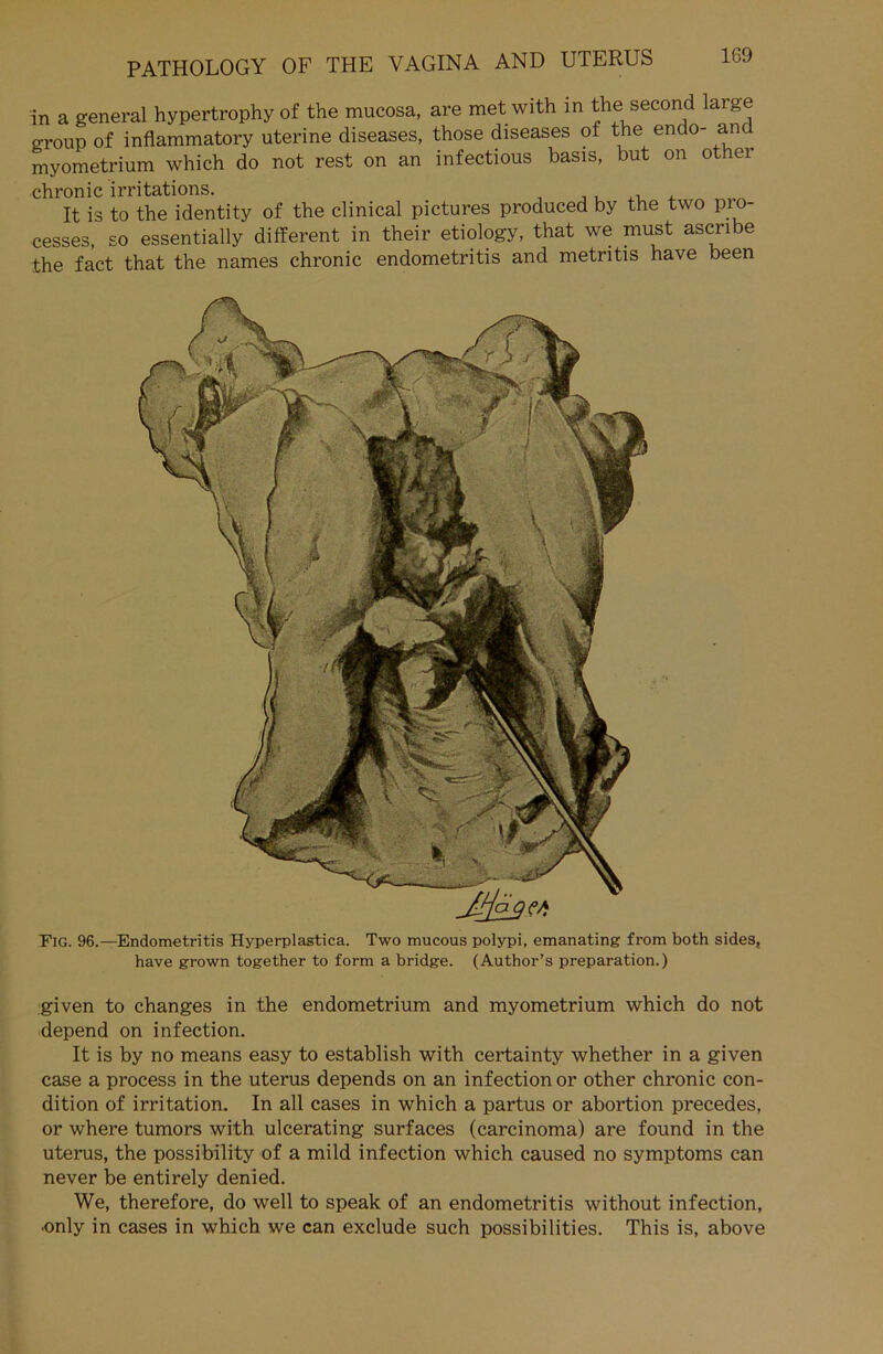 in a general hypertrophy of the mucosa, are met with in the second large group of inflammatory uterine diseases, those diseases of the endo- and myometrium which do not rest on an infectious basis, but on other chronic irritations. , , It is to the identity of the clinical pictures produced by the two pro- cesses, so essentially different in their etiology, that we must ascribe the fact that the names chronic endometritis and metritis have been FiG. 96.—Endometritis Hyperplastica. Two mucous polypi, emanating from both sides, have grown together to form a bridge. (Author’s preparation.) given to changes in the endometrium and myometrium which do not depend on infection. It is by no means easy to establish with certainty whether in a given case a process in the uterus depends on an infection or other chronic con- dition of irritation. In all cases in which a partus or abortion precedes, or where tumors with ulcerating surfaces (carcinoma) are found in the uterus, the possibility of a mild infection which caused no Symptoms can never be entirely denied. We, therefore, do well to speak of an endometritis without infection, ■only in cases in which we can exclude such possibilities. This is, above