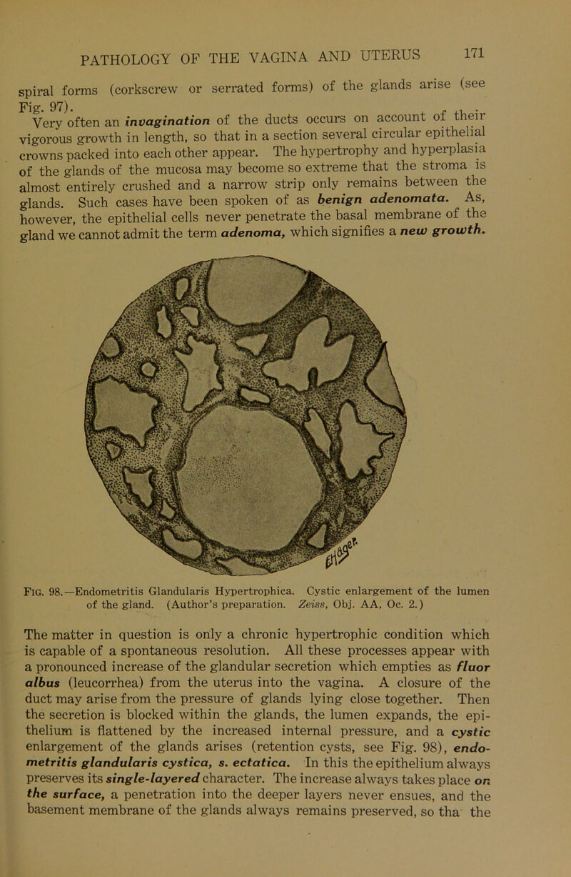 spiral forms (corkscrew or serrated forms) of the glands arise (see Fig. 97). « , . Yery often an invagination of the ducts occurs on account ot their vigorous growth in length, so that in a section several circular epithelial crowns packed into each other appear. The hypertrophy and hyperplasia of the glands of the mucosa may become so extreme that the stroma is almost entirely crushed and a narrow strip only remains between the glands. Such cases have been spoken of as benign adenomata. As, however, the epithelial cells never penetrate the basal membrane of the gland we cannot admit the term adenoma, which signifies a new growth. Fig. 98.—Endometritis Glandularis Hypertrophica. Cystic enlargement of the lumen of the gland. (Author’s preparation. Zeiss, Obj. AA, Oc. 2.) The matter in question is only a chronic hypertrophic condition which is capable of a spontaneous resolution. All these processes appear with a pronounced increase of the glandular secretion which empties as fluor albus (leucorrhea) from the uterus into the vagina. A closure of the duct may arise from the pressure of glands lying close together. Then the secretion is blocked within the glands, the lumen expands, the epi- thelium is flattened by the increased internal pressure, and a cystic enlargement of the glands arises (retention cysts, see Fig. 98), endo- metritis glandularis cystica, s. ectatica. In this the epithelium always preserves its single-layered character. The increase always takes place on the surface, a penetration into the deeper layers never ensues, and the basement membrane of the glands always remains preserved, so tha the