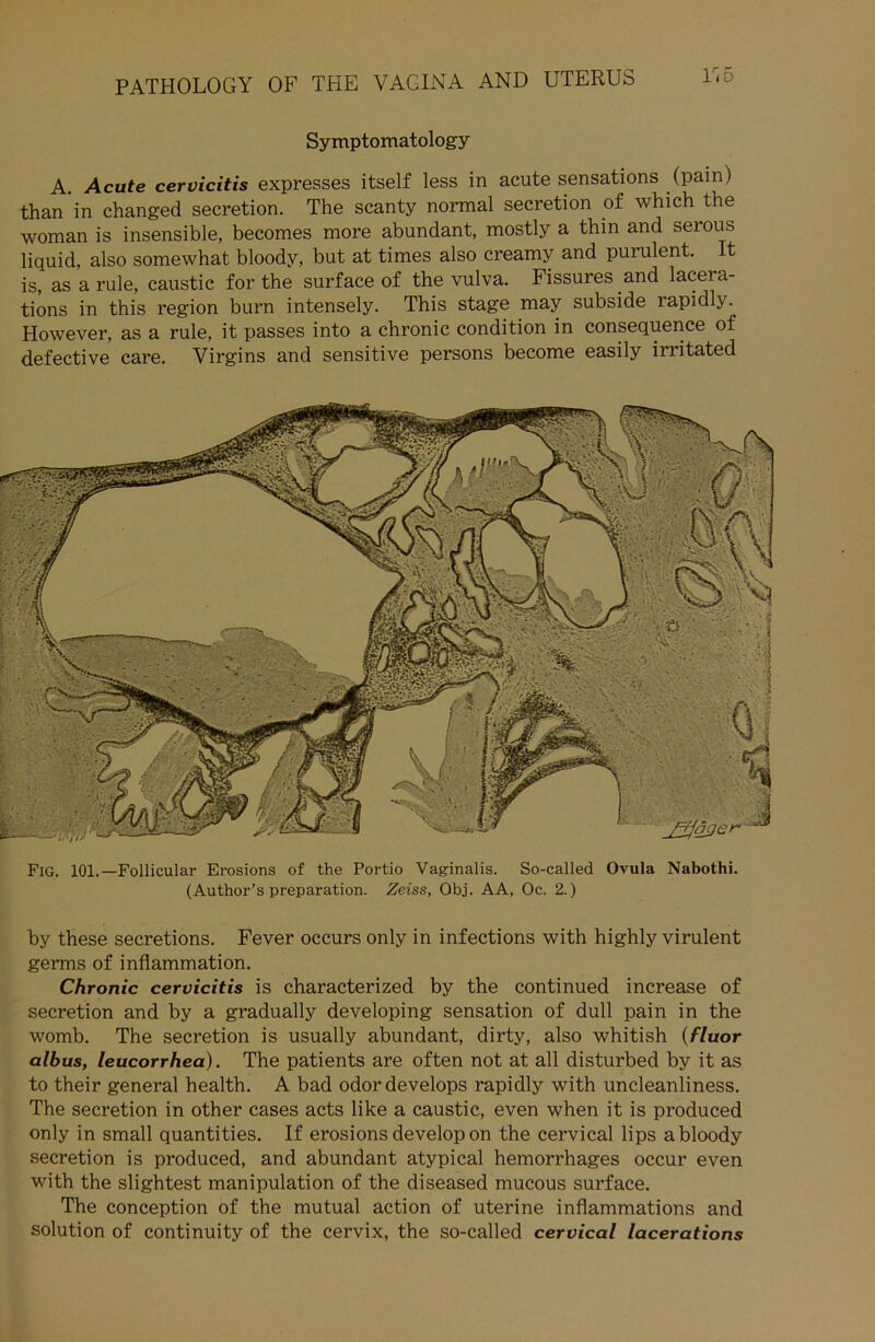 Symptomatology A. Acute cervicitis expresses itself less in acute sensations (pain) than in changed secretion. The scanty normal secretion of which the woman is insensible, becomes more abundant, mostly a thin and serous liquid, also somewhat bloody, but at times also creamy and purulent, is, as a rule, caustic for the surface of the vulva. Fissures and laceia- tions in this region burn intensely. This stage may subside lapidly. However, as a rule, it passes into a chronic condition in consequence of defective care. Virgins and sensitive persons become easily irritated FlG. 101.—Follicular Erosions of the Portio Vaginalis. So-called Ovula Nabothi. (Author’s preparation. Zeiss, Obj. AA, Oc. 2.) by these secretions. Fever occurs only in infections with highly virulent germs of inflammation. Chronic cervicitis is characterized by the continued increase of secretion and by a gradually developing Sensation of dull pain in the womb. The secretion is usually abundant, dirty, also whitish (fluor albus, leucorrhea). The patients are often not at all disturbed by it as to their general health. A bad odordevelops rapidly with uncleanliness. The secretion in other cases acts like a caustic, even when it is produced only in small quantities. If erosions develop on the cervical lips a bloody secretion is produced, and abundant atypical hemorrhages occur even with the slightest manipulation of the diseased mucous surface. The conception of the mutual action of uterine inflammations and solution of continuity of the cervix, the so-called cervical lacerations