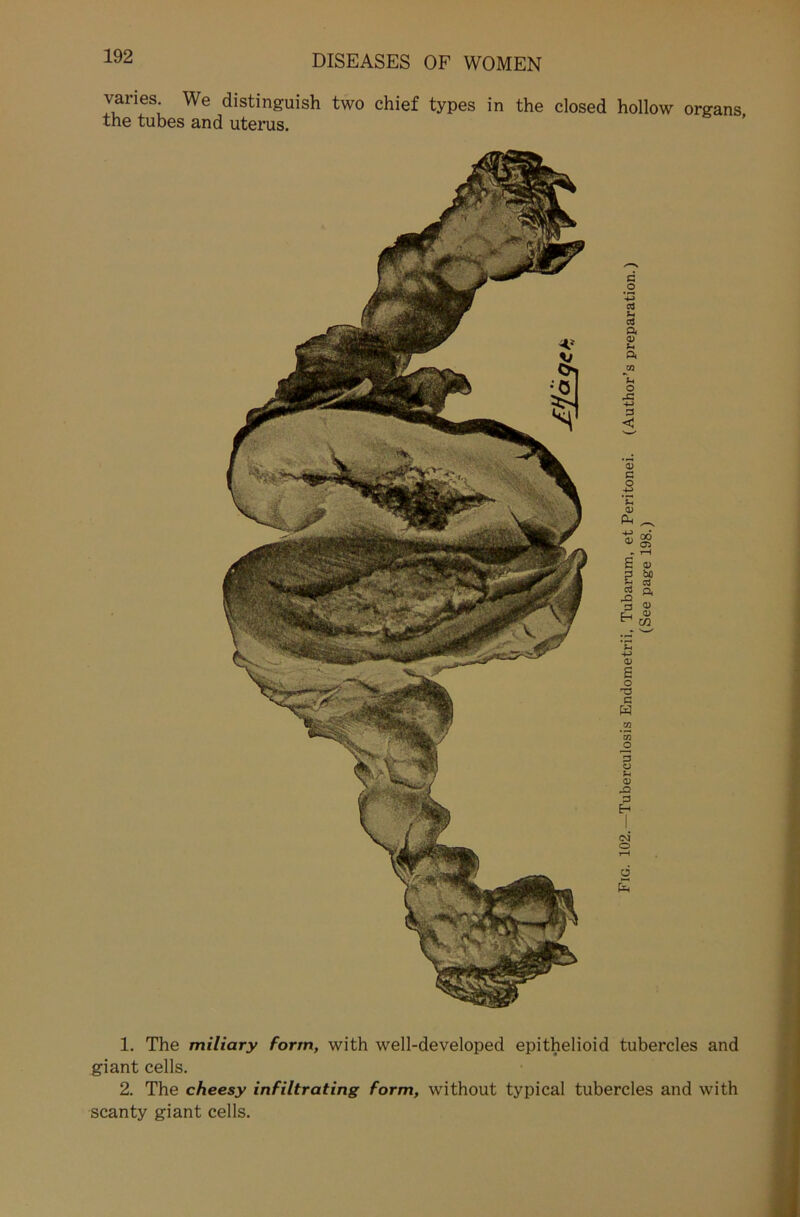 varies. We distinguish two chief types in the closed hollow organs the tubes and uterus. 1. The miliary form, with well-developed epithelioid tubercles and giant cells. 2. The cheesy infiltrating form, without typical tubercles and with scanty giant cells.