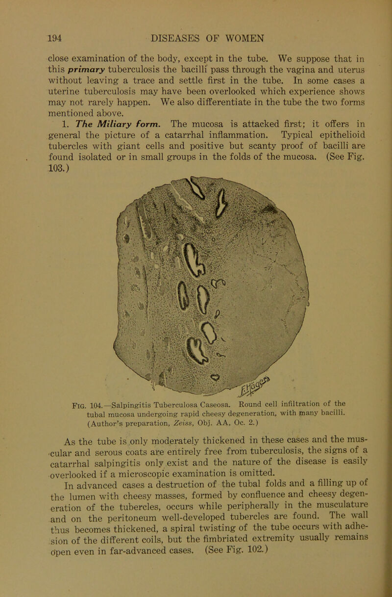 close examination of the body, except in the tube. We suppose that in this primary tuberculosis the bacilli pass through the vagina and uterus without leaving a trace and settle first in the tube. In some cases a uterine tuberculosis may have been overlooked which experience shows may not rarely happen. We also differentiate in the tube the two forms mentioned above. 1. The Miliary form. The mucosa is attacked first; it offers in general the picture of a catarrhal inflammation. Typical epithelioid tubercles with giant cells and positive but scanty proof of bacilli are found isolated or in small groups in the folds of the mucosa. (See Fig. 103.) FlG. 104.—Salpingitis Tuberculosa Caseosa. Round cell infiltration of the tubal mucosa undergoing rapid cheesy degeneration, with many bacilli. (Author’s preparation, Zeiss, Obj. AA, Oc. 2.) As the tube is only moderately thickened in these cases and the mus- cular and serous coats are entirely free from tuberculosis, the signs of a catarrhal salpingitis only exist and the nature of the disease is easily overlooked if a microscopic examination is omitted. In advanced cases a destruction of the tubal folds and a filling up of the lumen with cheesy masses, formed by confluence and cheesy degen- eration of the tubercles, occurs while peripherally in the musculature and on the peritoneum well-developed tubercles are found. The wall thus becomes thickened, a spiral twisting of the tube occurs with adhe- sion of the different coils, but the fimbriated extremity usually remains öpen even in far-advanced cases. (See Fig. 102.)