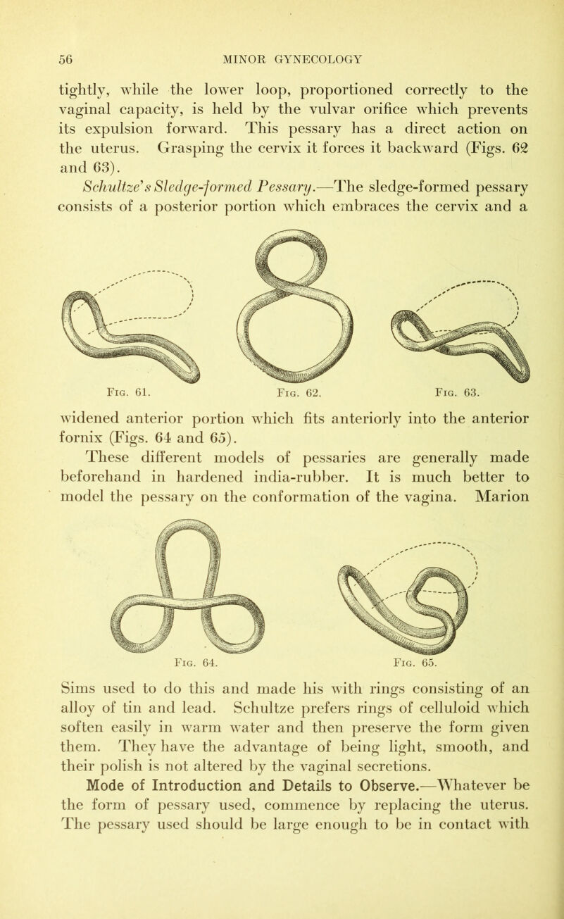 tightly, while the lower loop, proportioned correctly to the vaginal capacity, is held by the vulvar orifice which prevents its expulsion forward. This pessary has a direct action on the uterus. Grasping the cervix it forces it backward (Figs. 62 and 63). Schultze’s Sledge-formed Pessary.—The sledge-formed pessary consists of a posterior portion which embraces the cervix and a Fig. 61. Fig. 62. Fig. 63. widened anterior portion which fits anteriorly into the anterior fornix (Figs. 64 and 65). These different models of pessaries are generally made beforehand in hardened india-rubber. It is much better to model the pessary on the conformation of the vagina. Marion Fig. 64. Fig. 65. Sims used to do this and made his with rings consisting of an alloy of tin and lead. Schultze prefers rings of celluloid which soften easily in warm water and then preserve the form given them. They have the advantage of being light, smooth, and their polish is not altered by the vaginal secretions. Mode of Introduction and Details to Observe.—Whatever be the form of pessary used, commence by replacing the uterus. The pessary used should be large enough to be in contact with