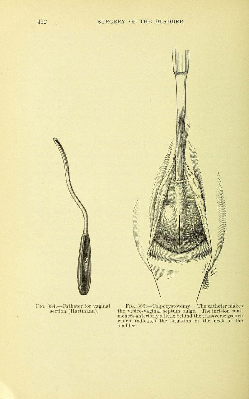 Fig. 384.—Catheter for vaginal section (Hartmann). Fig. 385.—Colpocystotomy. The catheter makes the vesico-vaginal septum bulge. The incision com- mences anteriorly a little behind the transverse groove which indicates the situation of the neck of the bladder.