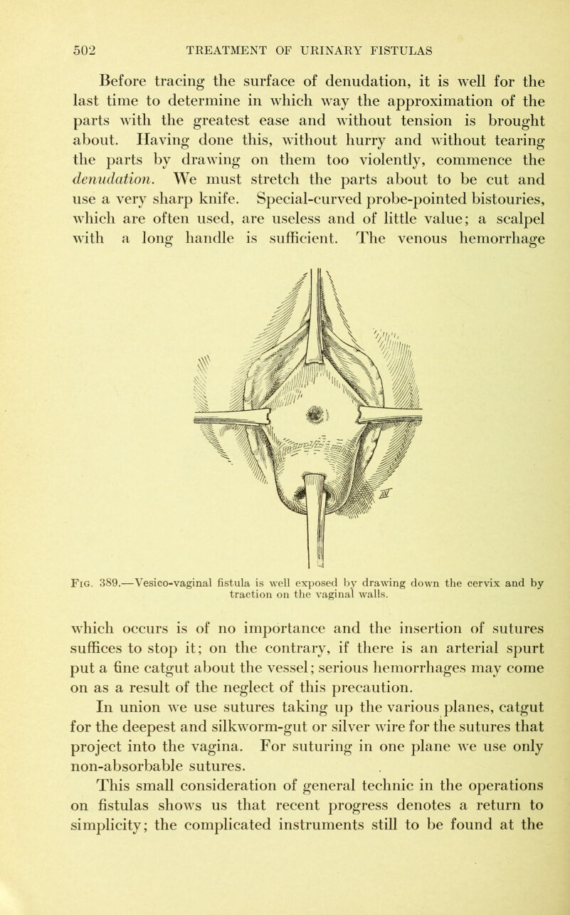 Before tracing the surface of denudation, it is well for the last time to determine in which way the approximation of the parts with the greatest ease and without tension is brought about. Having done this, without hurry and without tearing the parts by drawing on them too violently, commence the denudation. We must stretch the parts about to be cut and use a very sharp knife. Special-curved probe-pointed bistouries, which are often used, are useless and of little value; a scalpel with a long handle is sufficient. The venous hemorrhage Fig. 389.—Vesico-vaginal fistula is well exposed by drawing down the cervix and by traction on the vaginal walls. which occurs is of no importance and the insertion of sutures suffices to stop it; on the contrary, if there is an arterial spurt put a fine catgut about the vessel ; serious hemorrhages may come on as a result of the neglect of this precaution. In union we use sutures taking up the various planes, catgut for the deepest and silkworm-gut or silver wire for the sutures that project into the vagina. For suturing in one plane we use only non-absorbable sutures. This small consideration of general technic in the operations on fistulas shows us that recent progress denotes a return to simplicity; the complicated instruments still to be found at the