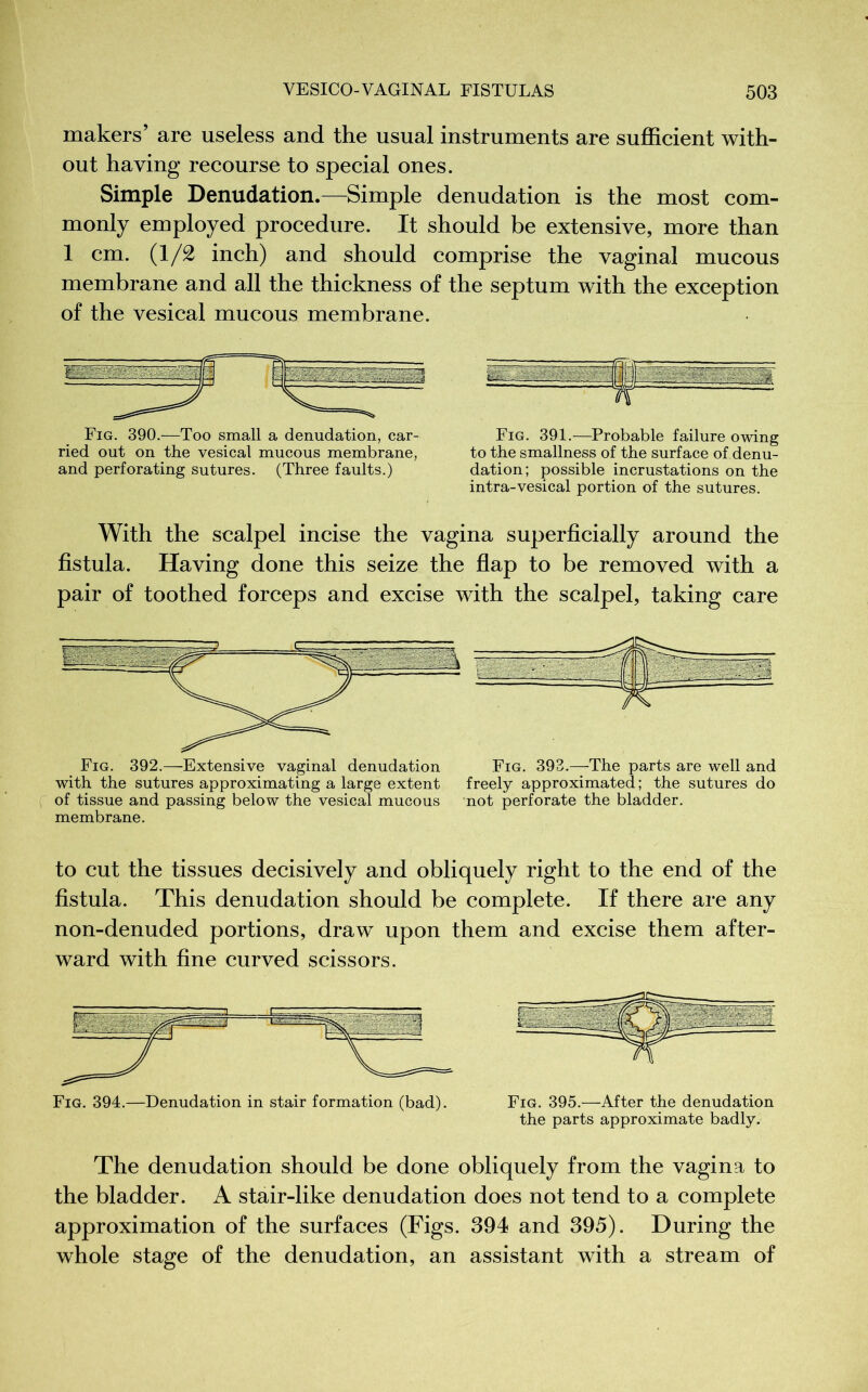 makers’ are useless and the usual instruments are sufficient with- out having recourse to special ones. Simple Denudation.—Simple denudation is the most com- monly employed procedure. It should be extensive, more than 1 cm. (1/2 inch) and should comprise the vaginal mucous membrane and all the thickness of the septum with the exception of the vesical mucous membrane. Fig. 390.—Too small a denudation, car- Fig. 391.—Probable failure owing ried out on the vesical mucous membrane, to the smallness of the surface of denu- and perforating sutures. (Three faults.) dation; possible incrustations on the intra-vesical portion of the sutures. With the scalpel incise the vagina superficially around the fistula. Having done this seize the flap to be removed with a pair of toothed forceps and excise with the scalpel, taking care Fig. 392.—-Extensive vaginal denudation Fig. 393.—The parts are well and with the sutures approximating a large extent freely approximated; the sutures do of tissue and passing below the vesical mucous not perforate the bladder, membrane. to cut the tissues decisively and obliquely right to the end of the fistula. This denudation should be complete. If there are any non-denuded portions, draw upon them and excise them after- ward with fine curved scissors. Fig. 394.—Denudation in stair formation (bad). Fig. 395.—After the denudation the parts approximate badly. The denudation should be done obliquely from the vagina to the bladder. A stair-like denudation does not tend to a complete approximation of the surfaces (Figs. 394 and 395). During the whole stage of the denudation, an assistant with a stream of