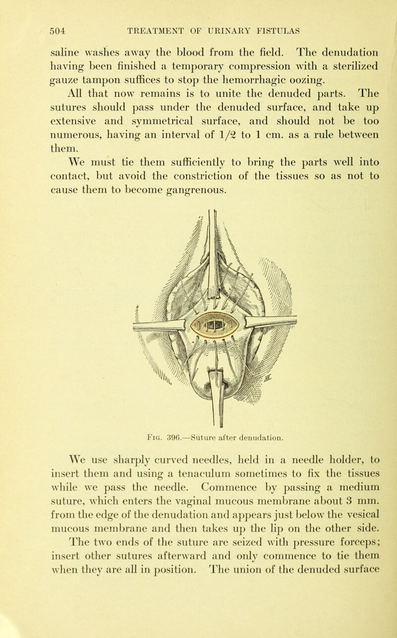 saline washes away the blood from the field. The denudation having been finished a temporary compression with a sterilized gauze tampon suffices to stop the hemorrhagic oozing. All that now remains is to unite the denuded parts. The sutures should pass under the denuded surface, and take up extensive and symmetrical surface, and should not be too numerous, having an interval of 1/2 to 1 cm. as a rule between them. We must tie them sufficiently to bring the parts well into contact, but avoid the constriction of the tissues so as not to cause them to become gangrenous. Fig. 396.—Suture after denudation. We use sharply curved needles, held in a needle holder, to insert them and using a tenaculum sometimes to fix the tissues while we pass the needle. Commence by passing a medium suture, which enters the vaginal mucous membrane about 3 mm. from the edge of the denudation and appears just below the vesical mucous membrane and then takes up the lip on the other side. The two ends of the suture are seized with pressure forceps; insert other sutures afterward and only commence to tie them when they are all in position. The union of the denuded surface