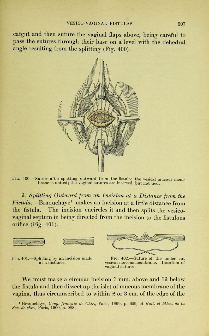catgut and then suture the vaginal flaps above, being careful to pass the sutures through their base on a level with the dehedral angle resulting from the splitting (Fig. 400). Fig. 400.—Suture after splitting outward from the fistula; the vesical mucous mem- brane is united; the vaginal sutures are inserted, but not tied. 2. Splitting Outward from an Incision at a Distance from the Fistula.—Braquehaye1 makes an incision at a little distance from the fistula, The incision encircles it and then splits the vesico- vaginal septum in being directed from the incision to the fistulous orifice (Fig. 401). Fig. 401.—Splitting by an incision made Fig. 402.—Suture of the under cut at a distance. vesical mucous membrane. Insertion of vaginal sutures. We must make a circular incision 7 mm. above and 12 below the fistula and then dissect up the islet of mucous membrane of the vagina, thus circumscribed to within 2 or 3 cm. of the edge of the 1 Braquehaye, Cong, français de Chir., Paris, 1899, p. 659, et Bull, et Mém. de la