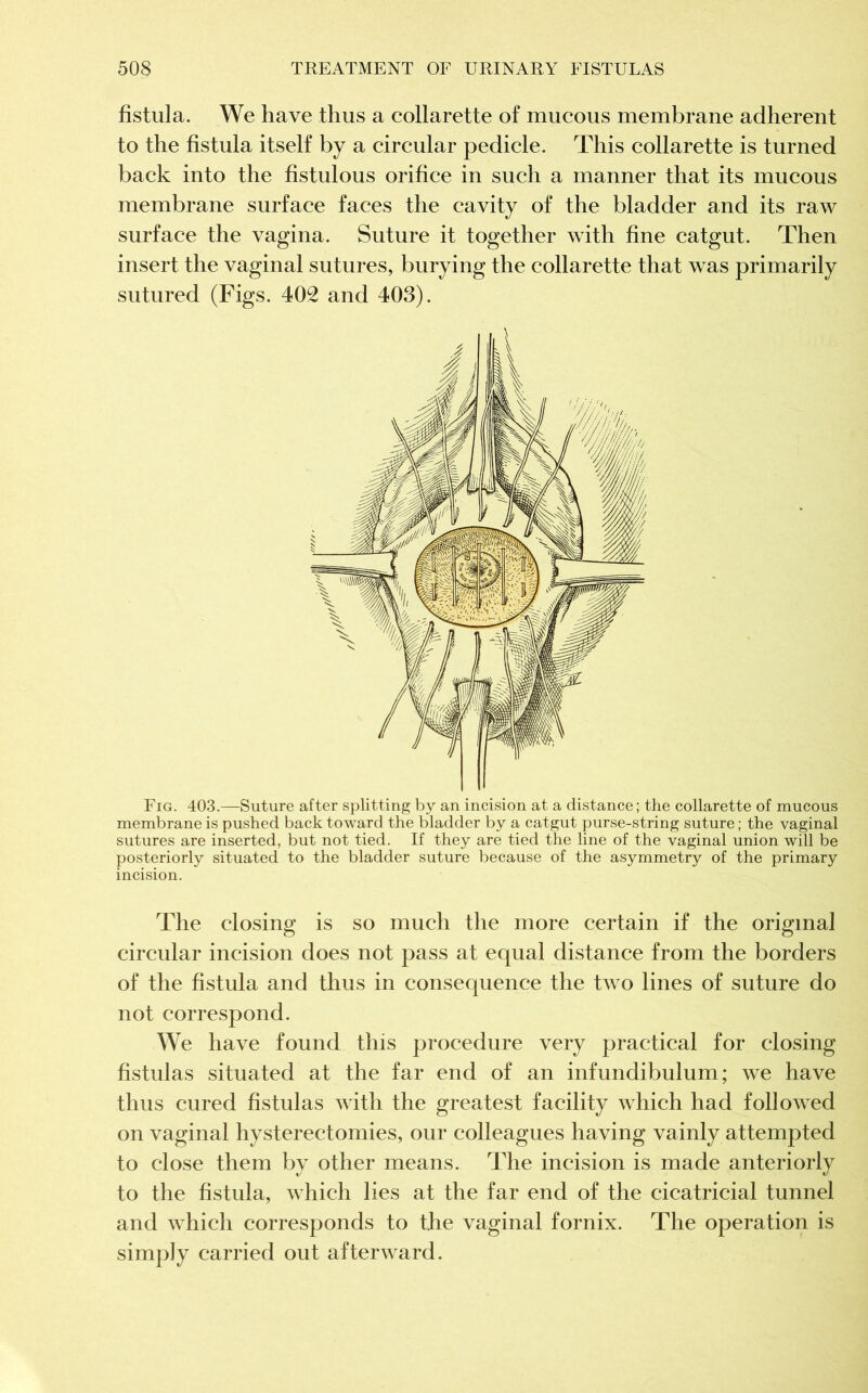 fistula. We have thus a collarette of mucous membrane adherent to the fistula itself by a circular pedicle. This collarette is turned back into the fistulous orifice in such a manner that its mucous membrane surface faces the cavity of the bladder and its raw surface the vagina. Suture it together with fine catgut. Then insert the vaginal sutures, burying the collarette that was primarily sutured (Figs. 402 and 403). Fig. 403.—Suture after splitting by an incision at a distance ; the collarette of mucous membrane is pushed back toward the bladder by a catgut purse-string suture ; the vaginal sutures are inserted, but not tied. If they are tied the line of the vaginal union will be posteriorly situated to the bladder suture because of the asymmetry of the primary incision. The closing is so much the more certain if the original circular incision does not pass at equal distance from the borders of the fistula and thus in consequence the two lines of suture do not correspond. We have found this procedure very practical for closing fistulas situated at the far end of an infundibulum; we have thus cured fistulas with the greatest facility which had followed on vaginal hysterectomies, our colleagues having vainly attempted to close them by other means. The incision is made anteriorly to the fistula, which lies at the far end of the cicatricial tunnel and which corresponds to the vaginal fornix. The operation is simply carried out afterward.
