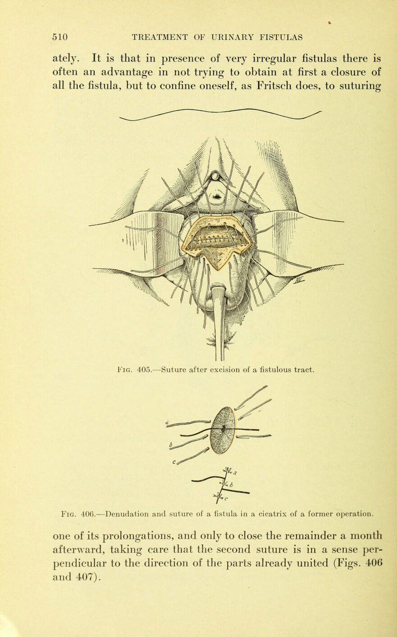 ately. It is that in presence of very irregular fistulas there is often an advantage in not trying to obtain at first a closure of all the fistula, but to confine oneself, as Fritsch does, to suturing Fig. 405.—Suture after excision of a fistulous tract. Fig. 406.—Denudation and suture of a fistula in a cicatrix of a former operation. one of its prolongations, and only to close the remainder a month afterward, taking care that the second suture is in a sense per- pendicular to the direction of the parts already united (Figs. 406 and 407).