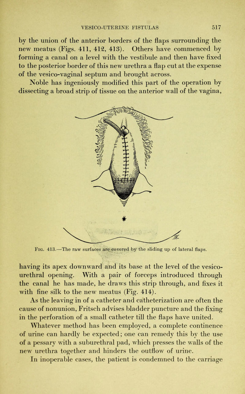 by the union of the anterior borders of the flaps surrounding the new meatus (Figs. 411, 412, 413). Others have commenced by forming a canal on a level with the vestibule and then have fixed to the posterior border of this new urethra a flap cut at the expense of the vesico-vaginal septum and brought across. Noble has ingeniously modified this part of the operation by dissecting a broad strip of tissue on the anterior wall of the vagina, Fig. 413.—The raw surfaces are co vered by the sliding up of lateral flaps. having its apex downward and its base at the level of the vesico- urethral opening. With a pair of forceps introduced through the canal he has made, he draws this strip through, and fixes it with fine silk to the new meatus (Fig. 414). As the leaving in of a catheter and catheterization are often the cause of nonunion, Fritsch advises bladder puncture and the fixing in the perforation of a small catheter till the flaps have united. Whatever method has been employed, a complete continence of urine can hardly be expected; one can remedy this by the use of a pessary with a suburethral pad, which presses the walls of the new urethra together and hinders the outflow of urine. In inoperable cases, the patient is condemned to the carriage