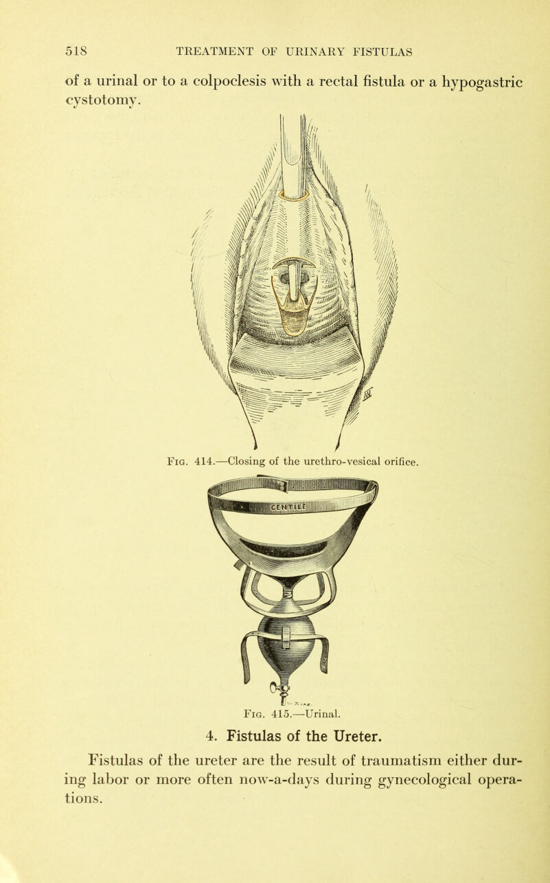of a urinal or to a colpoclesis with a rectal fistula or a hypogastric cystotomy. Fig. 415.—Urinal. 4. Fistulas of the Ureter. Fistulas of the ureter are the result of traumatism either dur- ing labor or more often now-a-days during gynecological opera- tions.